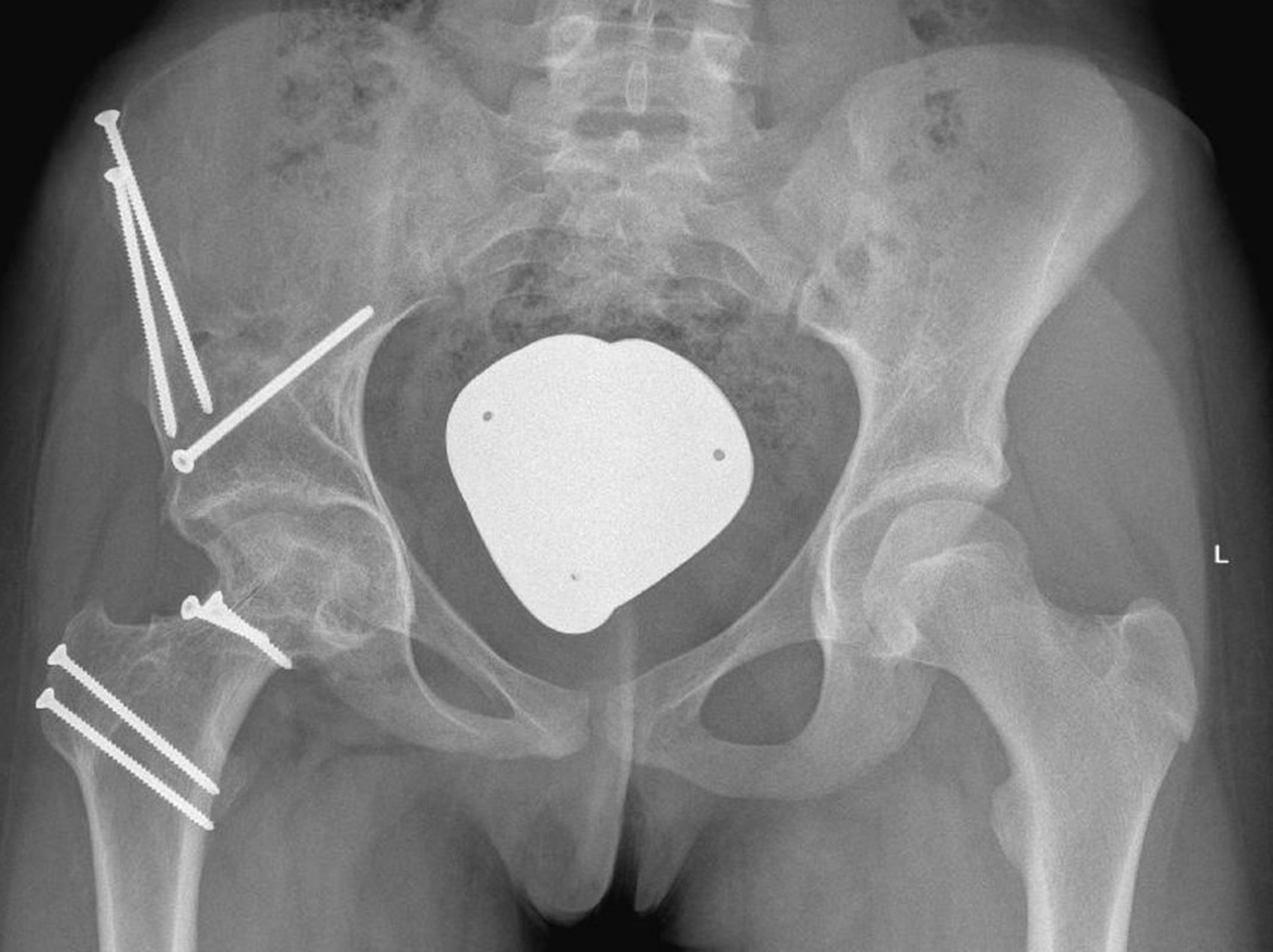 Fig. 5 
            Case two: Anteroposterior pelvic radiograph control 19 months after surgery showing healed osteotomies, and a well reduced, vital femoral head.
          
