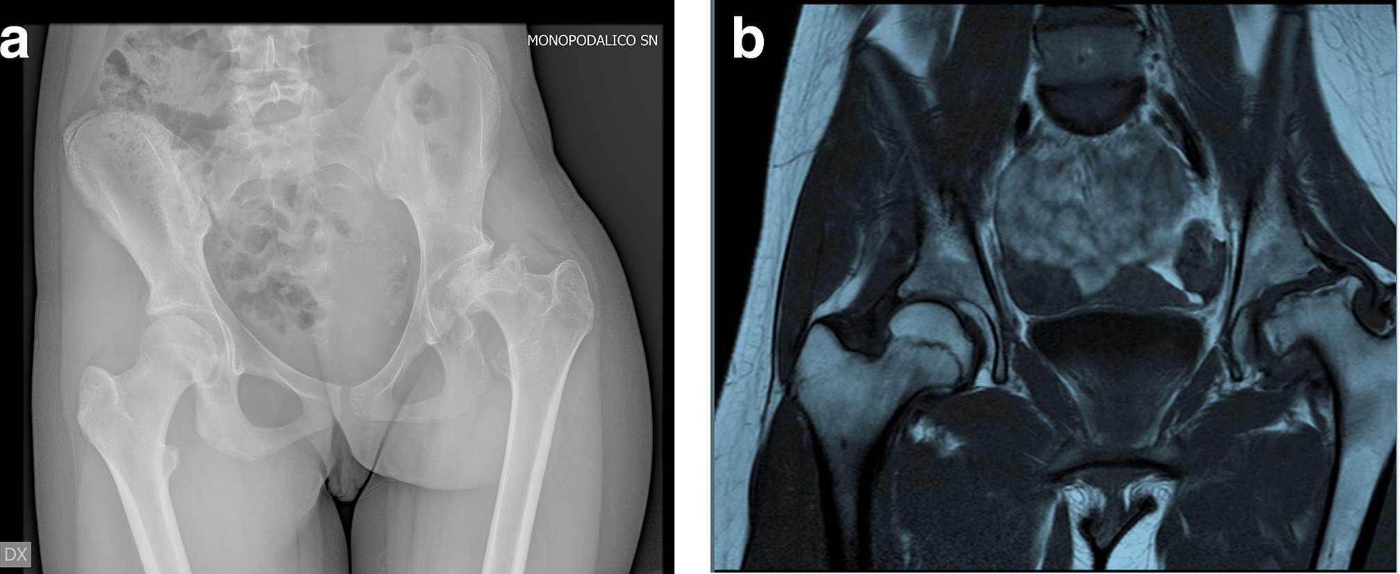 Fig. 6 
            Case three: a) Preoperative anteroposterior pelvic radiograph and pelvic MRI with large epiphyseal necrosis of the left femoral head, especially of the lateral pillar. Femoral head subluxation and severe hip contracture in adduction. b) MRI showing an almost total head involvement.
          
