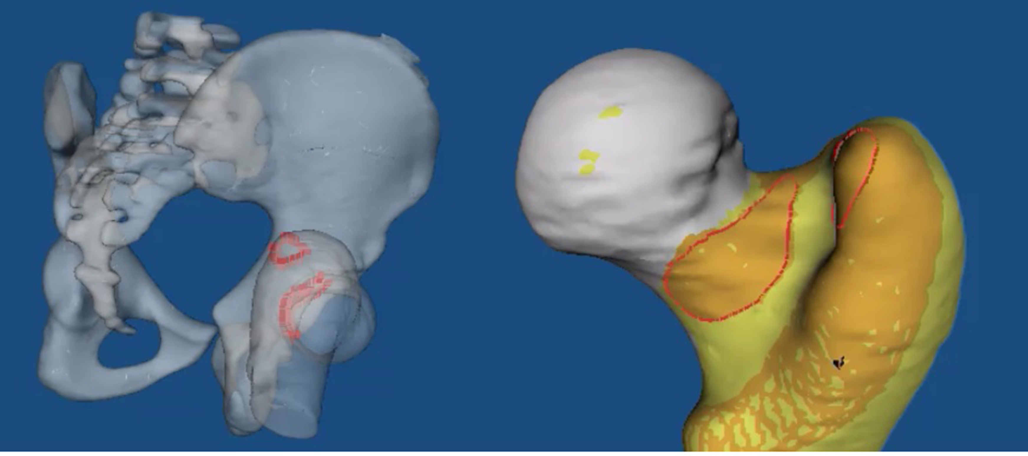 Fig. 7 
          Case one: 3D reconstruction and simulation of range of motion shows contact between posterosuperior neck and posterior-inferior rim when the hyperextended femur was externally rotated. The contact area on the posterior neck is coextensive with the retinaculum containing the mean blood suppliers of the femoral head.
        