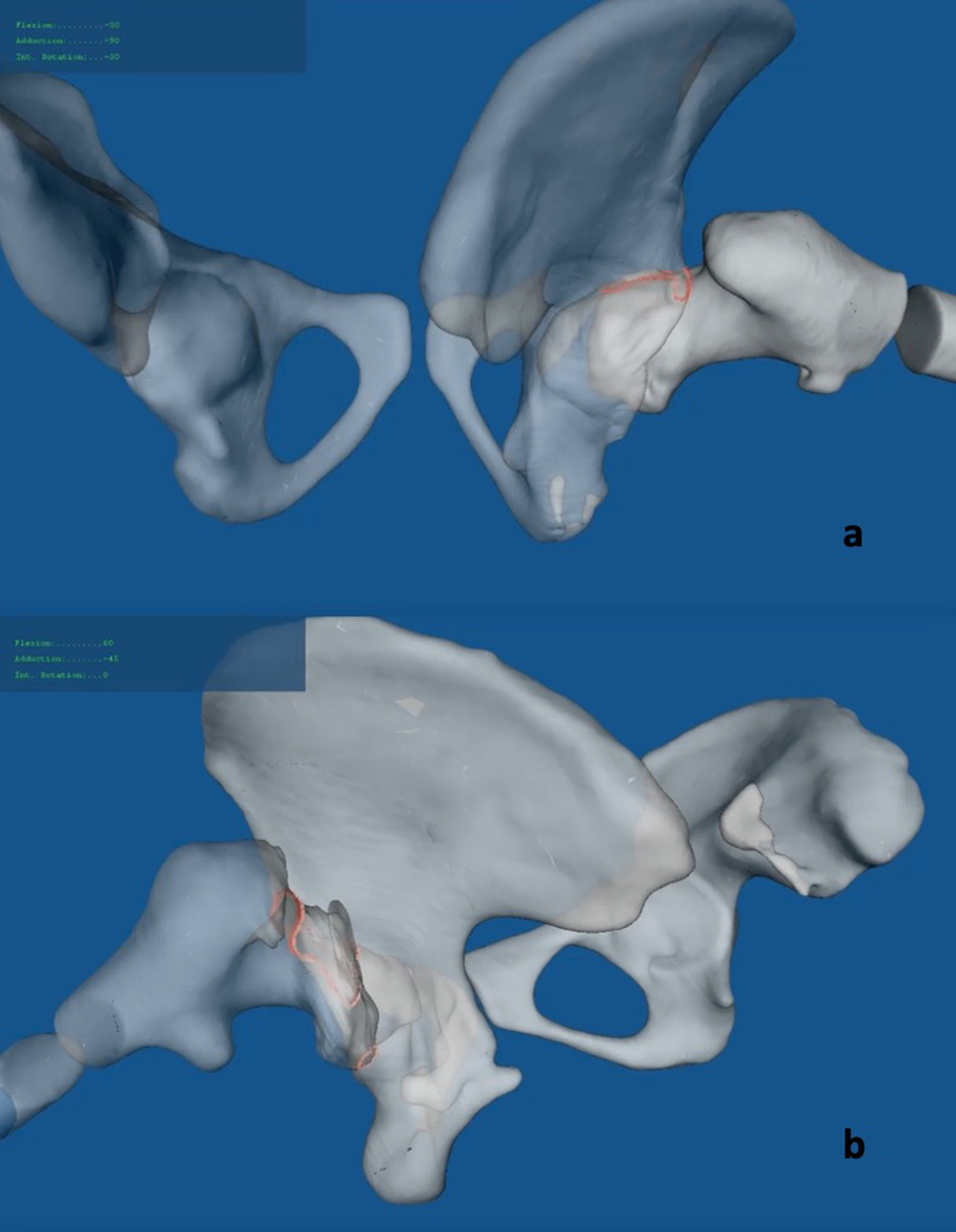 Fig. 8 
          Contact between the retinaculum and the acetabular rim in the affected hip during the 3D animation was seen in a) case two: 30° extension combined with 30° external rotation and approximately 90° abduction, respectively; and b) case three: 45° abduction combined with 60° flexion (men’s splits).
        
