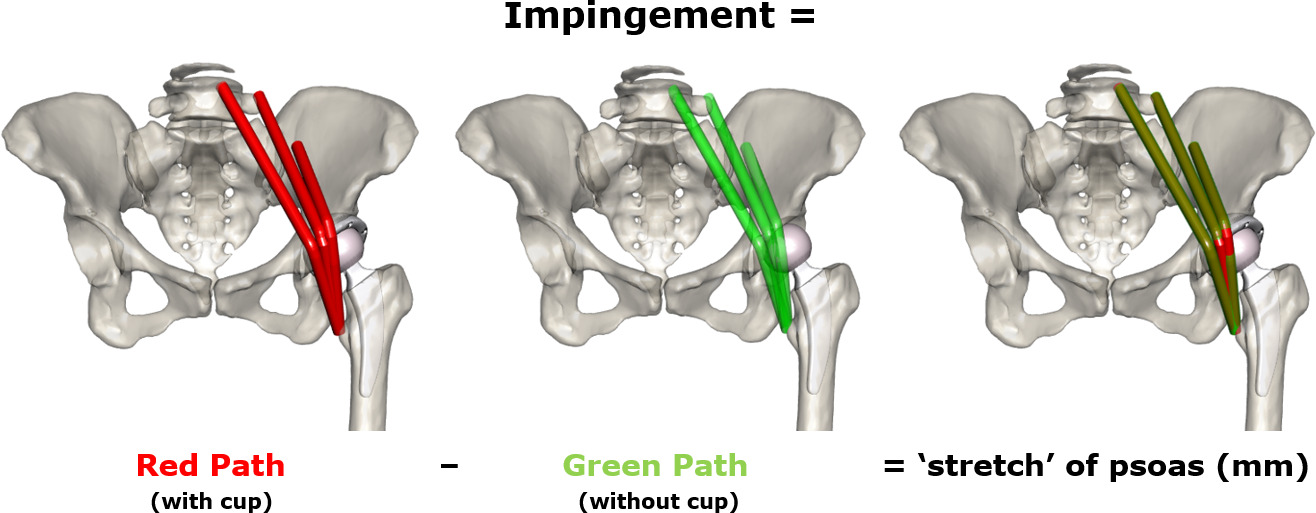 Fig. 3 
            Schematic of the iliopsoas impingement simulation in a patient’s standing pelvic position. Three segments were chosen as they approximate the width of the iliopsoas and the location it passes over the acetabular margin. These segments are composed of two paths: a green and a red path. The green path does not include the cup and the red path does. The difference between these paths is equal to the impingement, and could be considered the ‘stretch’ of the iliopsoas due to the cup.
          