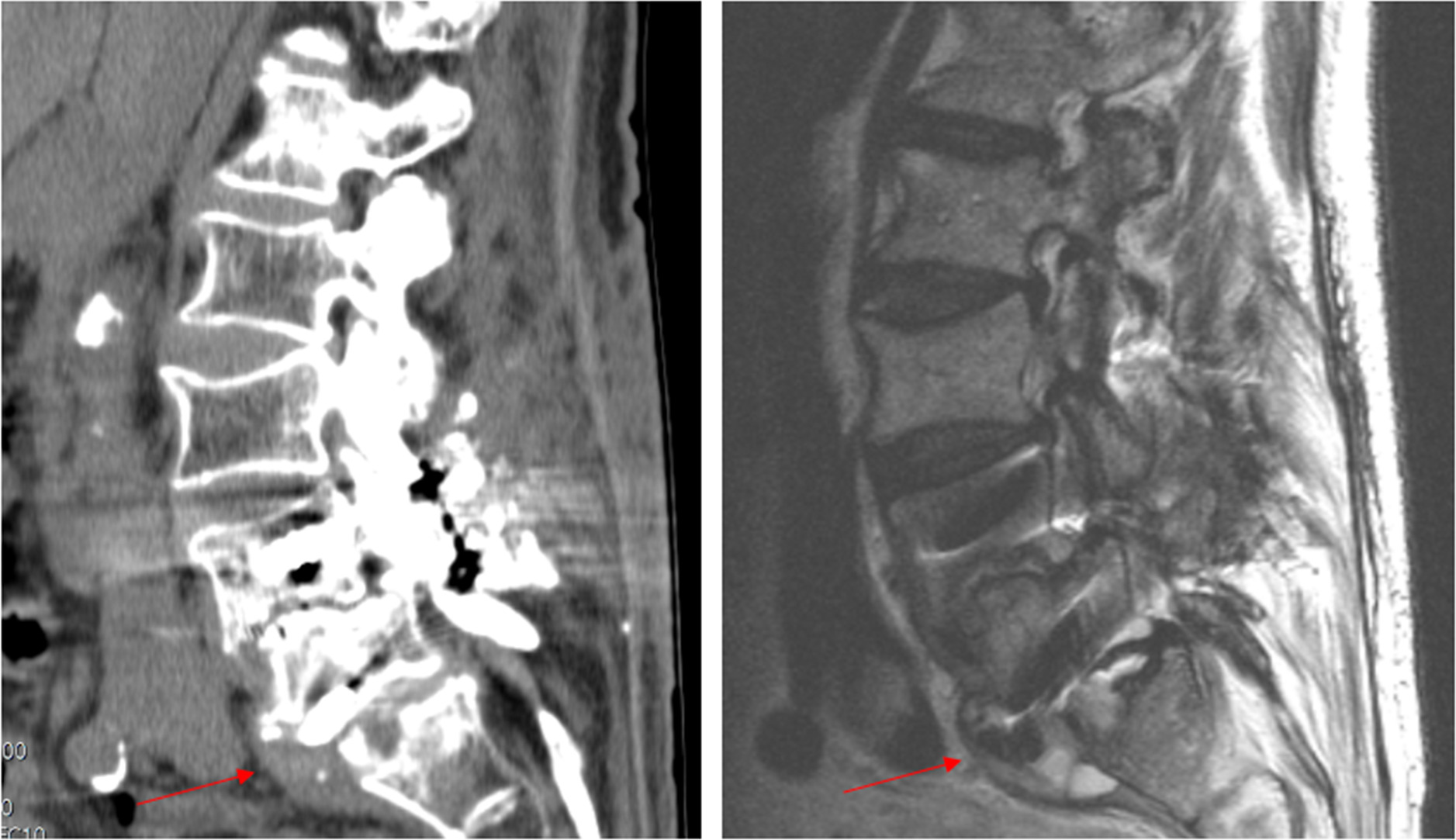 Fig. 2 
          Showcase of difference in visibility of paravertebral manifestations of infection in CT (left) and MRI (right). The patient was a 68-year-old female with implant-related spondylodiscitis L5/S1 and anterior abscess formation as indicated by the red arrow.
        