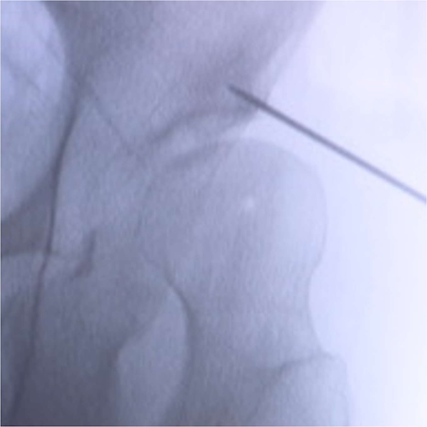 Fig. 1 
            Intraoperative anteroposterior radiograph using a fluoroscope. During the surgery, two 2.0 mm Kirschner (K-) wires were temporarily inserted, one each from the anterior and posterior ends of the bone slot, and were pointed in the direction of the planned shelf. The height and orientation of the shelf were determined under fluoroscopy, based on findings from these two K-wires.
          