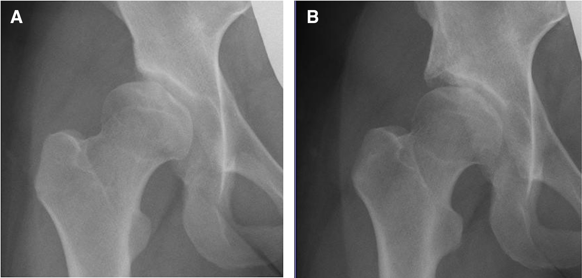 Fig. 3 
            Radiographs of a 23-year-old female who had undergone a modified Spitzy shelf acetabuloplasty on the right hip: a) preoperatively, osteoarthritis Tönnis grade 0, a lateral centre-edge angle of 9° (Merle d’Aubigné clinical score, 14 points), and b) at ten years postoperatively, no osteoarthritis changes, a lateral centre-edge angle of 37° (Merle d’Aubigné clinical score, 18 points).
          