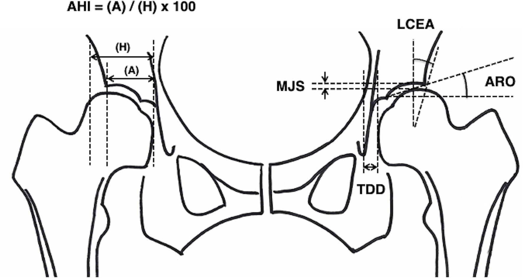 Fig. 4 
            Radiographical parameters for evaluation: a) minimum joint space (MJS), b) lateral centre-edge angle (LCEA), c) acetabular head index (AHI), d) acetabular roof obliquity (ARO), and e) tear drop distance (TDD).
          