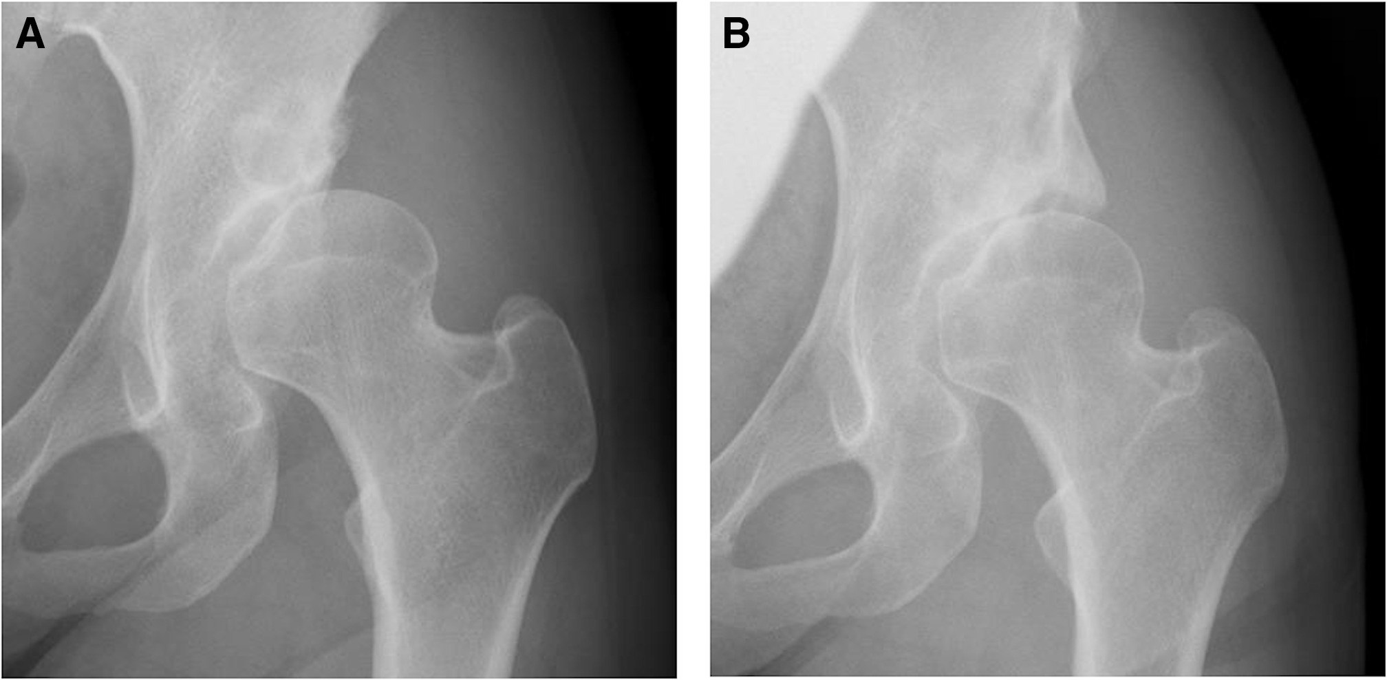 Fig. 6 
          Radiographs ofa 44-year-old female who had undergone a modified Spitzy shelf acetabuloplasty on the left hip: a) preoperatively, osteoarthritis Tönnis grade 2 with bone cyst, a lateral centre-edge angle of 0° (Merle d’Aubigné clinical score, 8 points), and b) at 12 years postoperatively, osteoarthritis Tönnis grade 2, a lateral centre-edge angle of 35° (Merle d’Aubigné clinical score, 16 points).
        