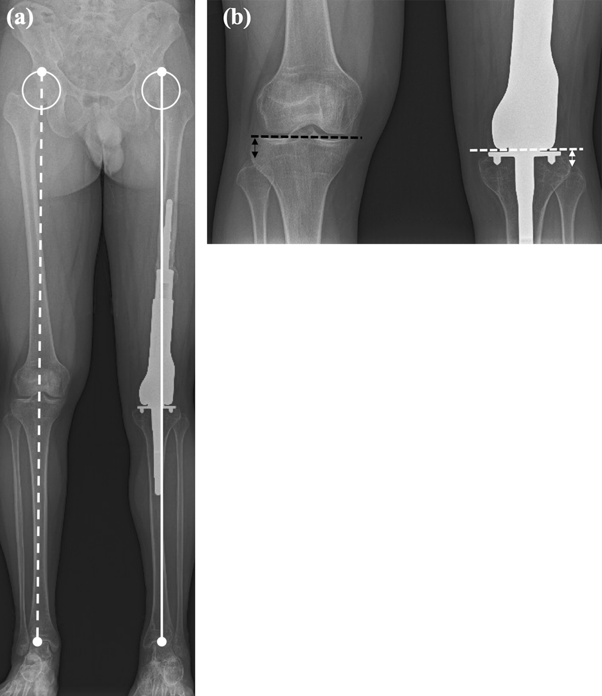 Fig. 2 
            a) Leg length was measured as the distance between the top of the femoral head and the centre of the ankle joint. The leg length discrepancy with the opposite lower leg was calculated. b) Measurement of joint line height. On the operative side, the distance from the fibular head to a line connecting the most distal points of the medial and lateral femoral condyle (white dashed line) was measured. On the opposite side, the distance from the fibular head to the mid-line through the joint space (black dashed line) was measured.
          