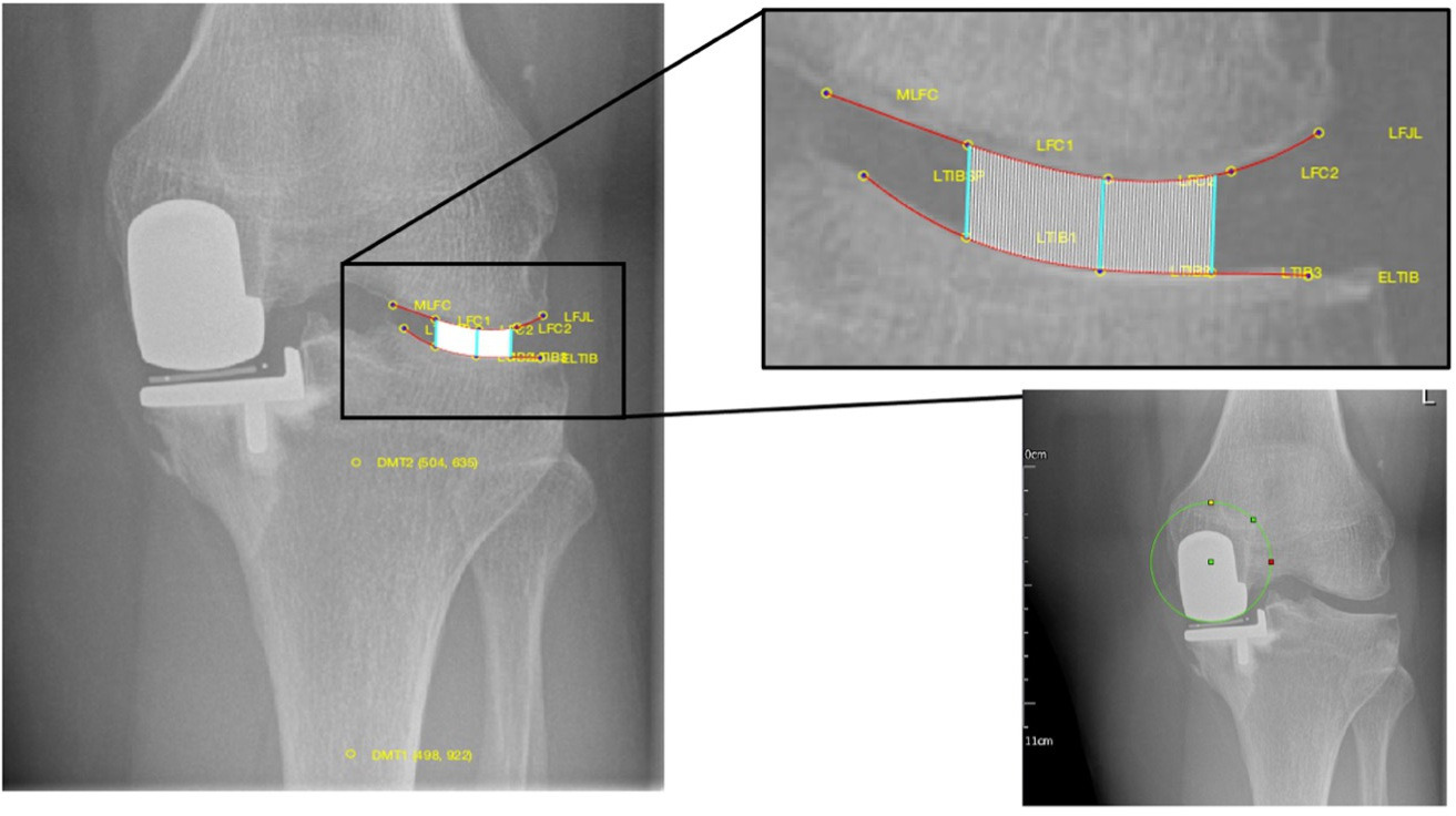 Fig. 1 
            Anterior-posterior radiograph of a 70-year-old male patient showing the method of measuring the lateral joint space width (JSWL). It involved drawing the mechanical axis of the tibia using midpoints of the proximal and distal tibia (left), identifying lateral femoral and tibial joint lines using five evenly spaced points on the respective surfaces (top right) and scaling the radiograph using the known component size (bottom right). Three lines from the tibial joint line were drawn to meet the femoral joint line parallel to the mechanical axis (top right) – the mean of these measurements determined the mean JSWL.
          