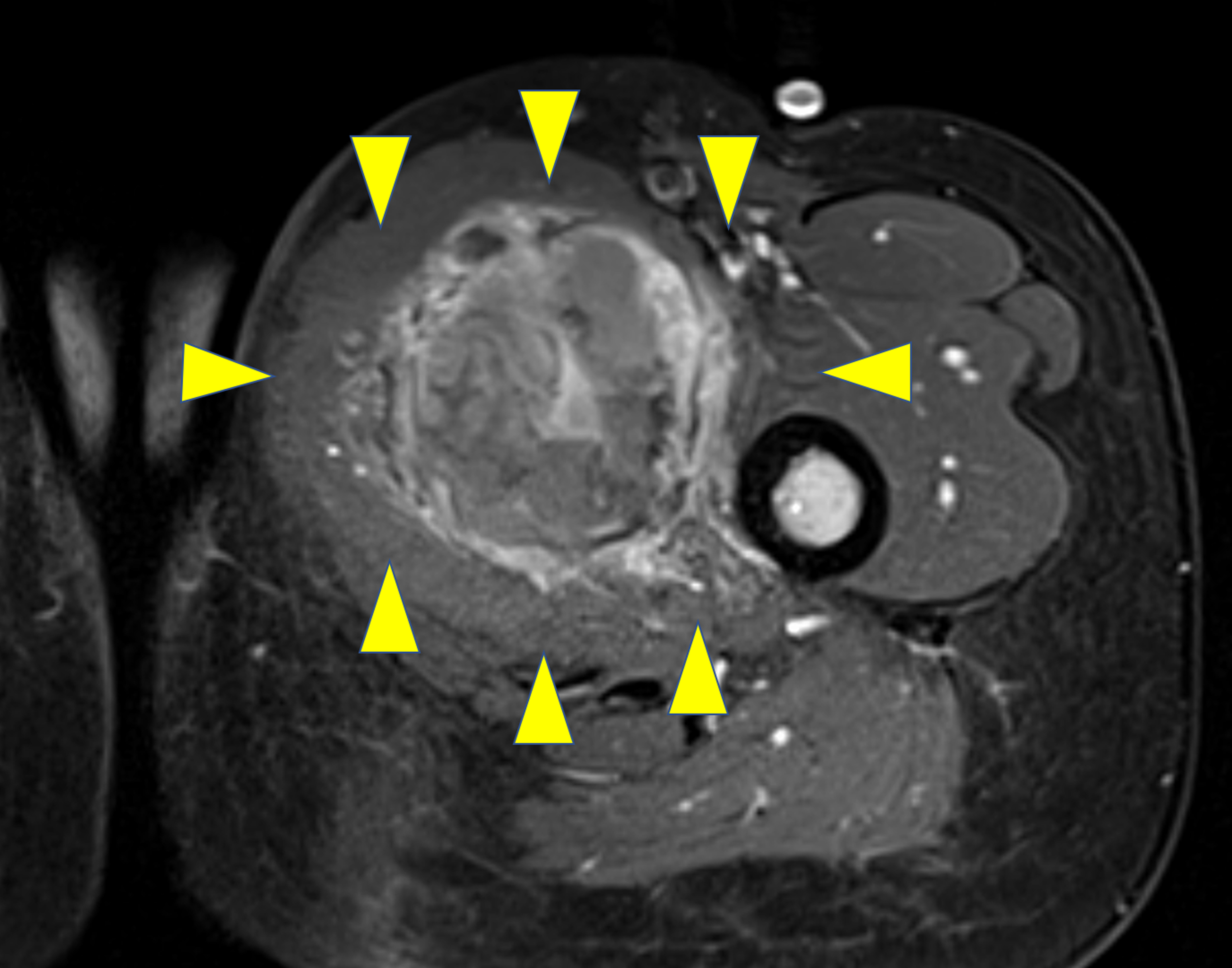 Fig. 1 
            Representative images of soft-tissue sarcoma arising in the medial thigh. Gadolinium-enhanced T1-weighted axial MRI images.
          