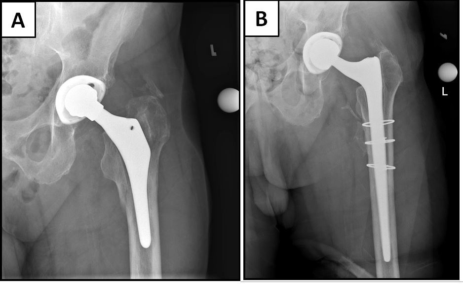 Fig. 1 
            a) Preoperative hip anteroposterior (AP) radiograph of 72-year-old male with Vancouver B2 periprosthetic fracture. b) Two-year postoperative AP hip radiograph with monoblock tapered fluted revision femoral stem with stem osseointegration.
          