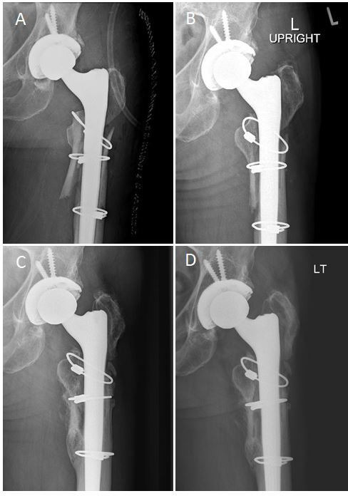 Fig. 2 
            Radiological sequelae of a 58-year-old female patient with subsidence which stabilized over time. a) Immediate postoperative anteroposterior (AP) left hip radiograph demonstating a Vancouver B2 periprosthetic fracture revised with a monoblock tapered fluted stem and three cerclage wires. b) One-month postoperative AP left hip radiograph demonstrating minor femoral implant subsidence compared to initial stem position in a). c) One-year postoperative AP left hip radiograph with continued femoral implant subsidence d) Two-year postoperative AP left hip radiograph with stabilized femoral implant subsidence.
          