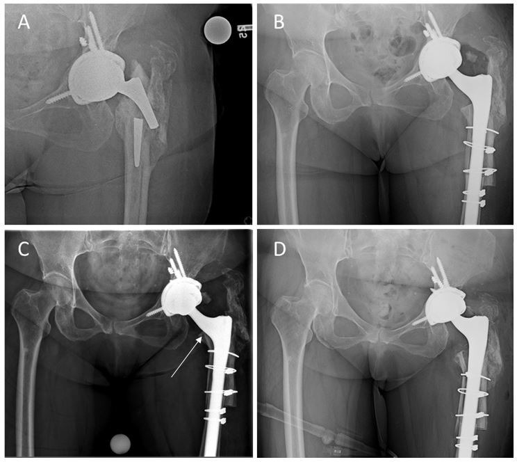 Fig. 3 
            Radiological sequelae of a 61-year-old female who did not achieve osseointegration. a) Preoperative anteroposterior (AP) hip radiograph of a Vancouver B2 fracture, as well as a femoral stem fracture following a minor trauma. b) Immediate postoperative AP pelvis radiograph demonstrating a revised femoral implant using a monoblock tapered fluted revision femoral stem and cerclage wires. c) Four weeks postoperative AP pelvis radiograph showing a femoral stem subsidence compared to the immediate postoperative radiograph. d) Immediate postoperative AP pelvis radiograph following re-revision surgery with a monoblock tapered fluted revision femoral stem.
          