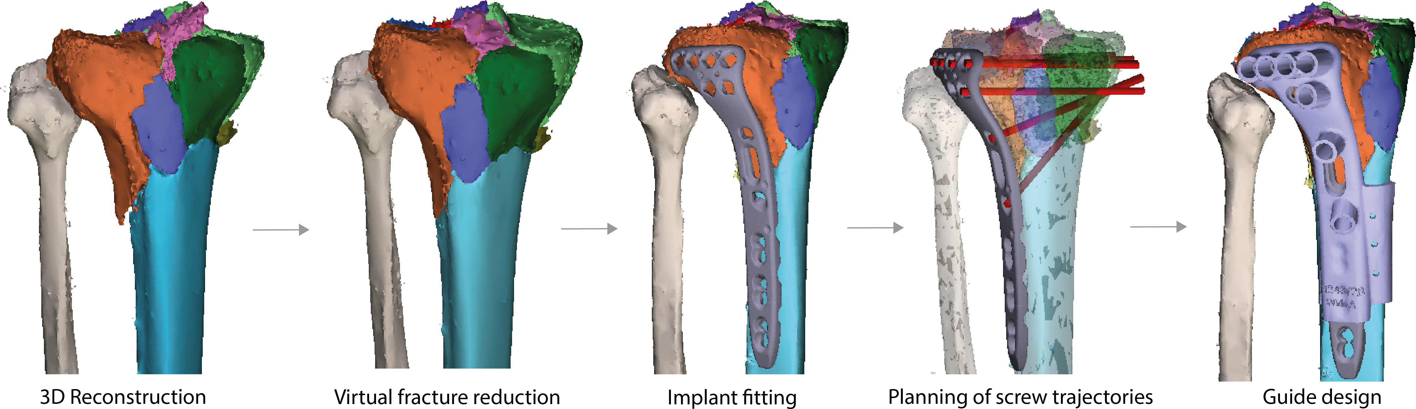 Fig. 1 
            Process of 3D surgical planning including patient-specific drilling guide design. First, a 3D reconstruction is created from the initial CT scan in which all fragments are identified and assigned a different colour. Then, virtual fracture reduction is performed, after which a plate is digitally fitted and screw trajectories (red bars) are predetermined. Finally, the drilling guide is designed to envelop the variable angle-locking compression plate (VA-LCP) to guide the drill bit and screw in the planned trajectories. To position the plate at the intended location, bone-supporting extensions were added to the design of the guide. The guide is subsequently 3D-printed and used during the operation to convert the virtual plan to the patient.
          