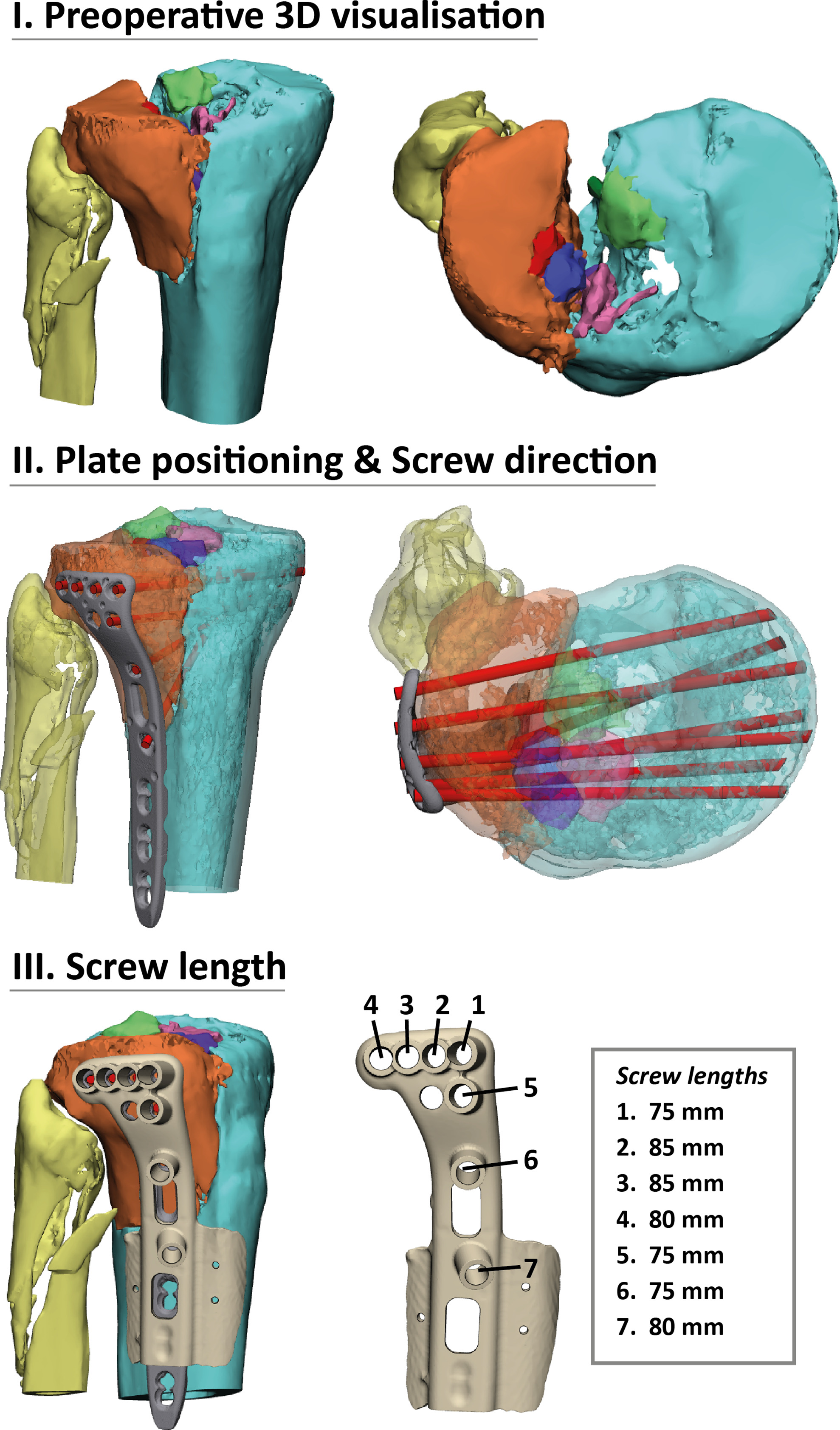 Fig. 2 
            3D virtual surgical planning including visualization of the fracture (I), visualization of the planned position of the plate and directions of screws (II), and the lengths of the screws (III). A 3D-printed guide that fits on top of the plate (III) is used to translate the preoperative plan (e.g. guiding plate position, screw directions, screw lengths) to the actual operative procedure.
          