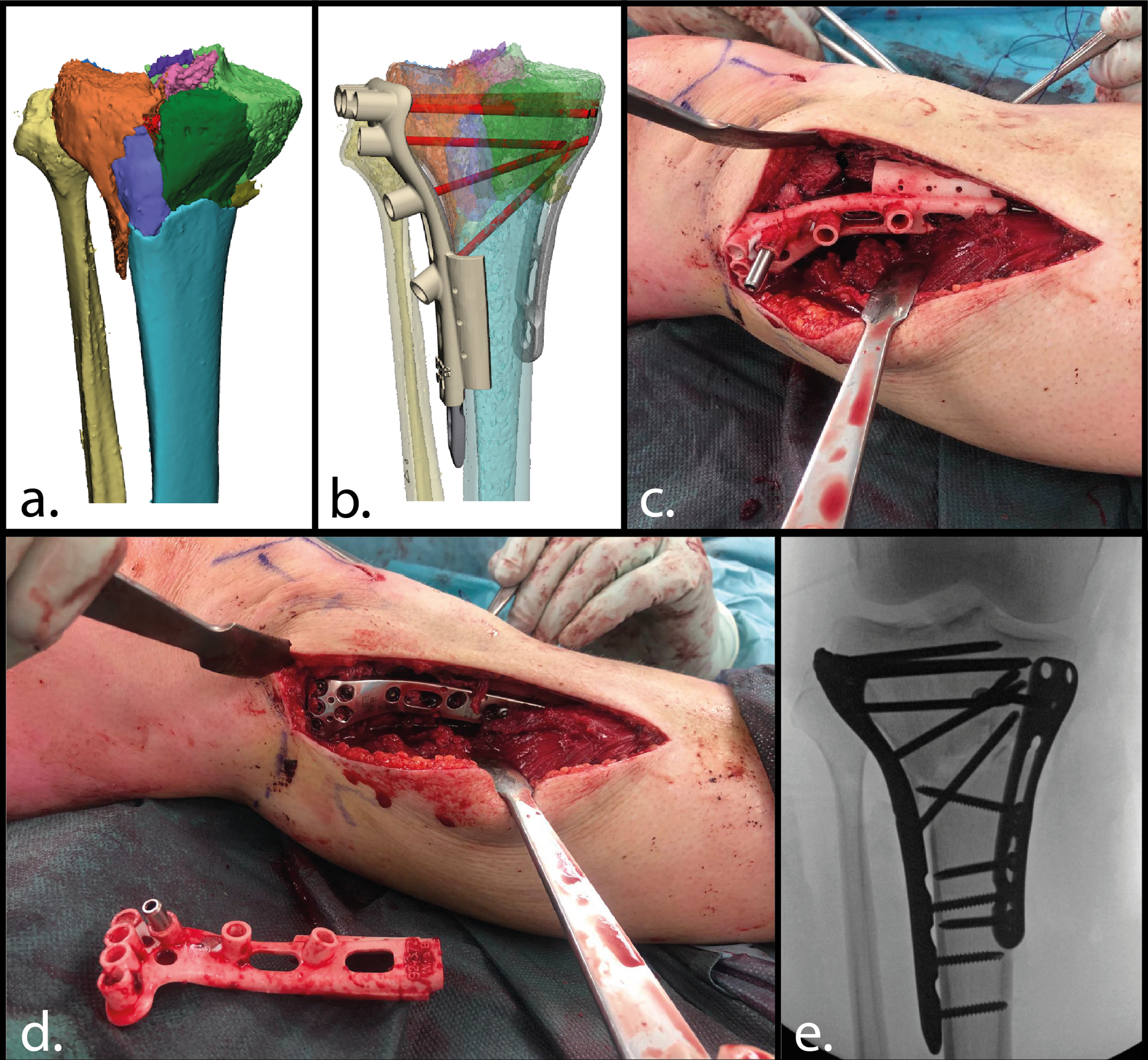 Fig. 3 
            3D-assisted surgery in case 3. a) Preoperative 3D visualization of the fracture. b) Virtual surgical planning. c) Intraoperative use of the 3D-printed surgical drilling guides. Screw trajectories are drilled through the stainless-steel drill sleeve. d) Osteosynthesis plate after screw placement. e) Fluoroscopic image of the achieved surgical result.
          