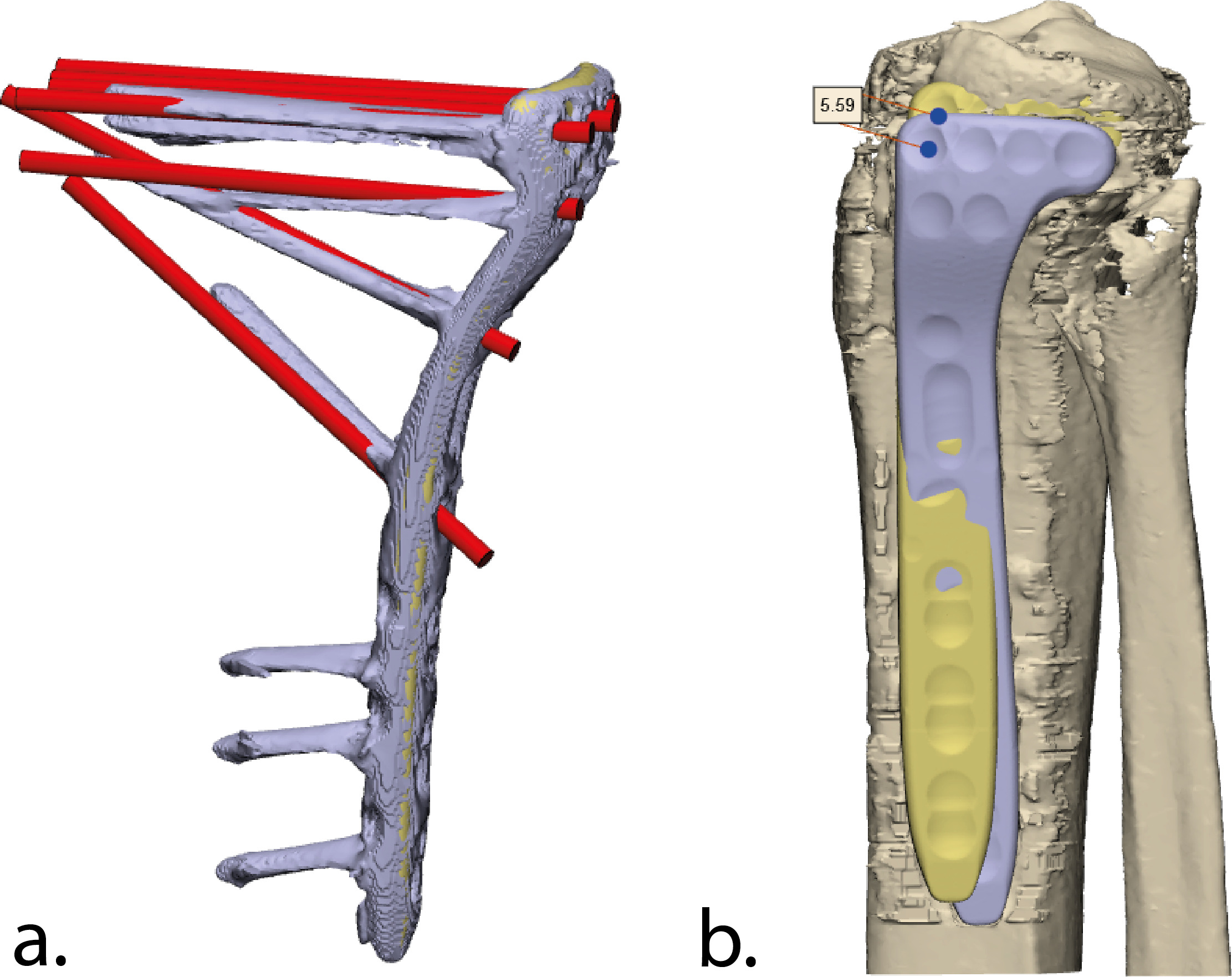 Fig. 4 
            Postoperative assessment of the accuracy of the screw placement. a) The difference between the achieved (purple) and obtained (red) screw directions were assessed by measuring the angle between those screw trajectories. b) The planned (yellow) and obtained (purple) position of the implant. The difference between the planned and the obtained screw entry points were determined for all screws by measuring the Euclidean distance between these entry points.
          