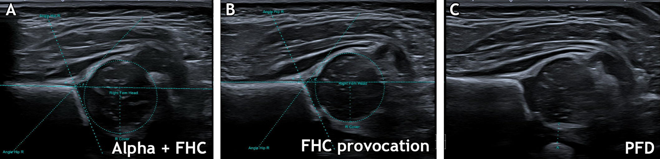 Fig. 1 
            Three ultrasound images of one paediatric hip examination. a) Graf standard plane with added annotated α angles and femoral head coverage (FHC) values. b) Ultrasound image captured during hip provocation with annotated FHC values. c) Ultrasound image captured during hip provocation with annotated pubofemoral distance (PFD) values.
          
