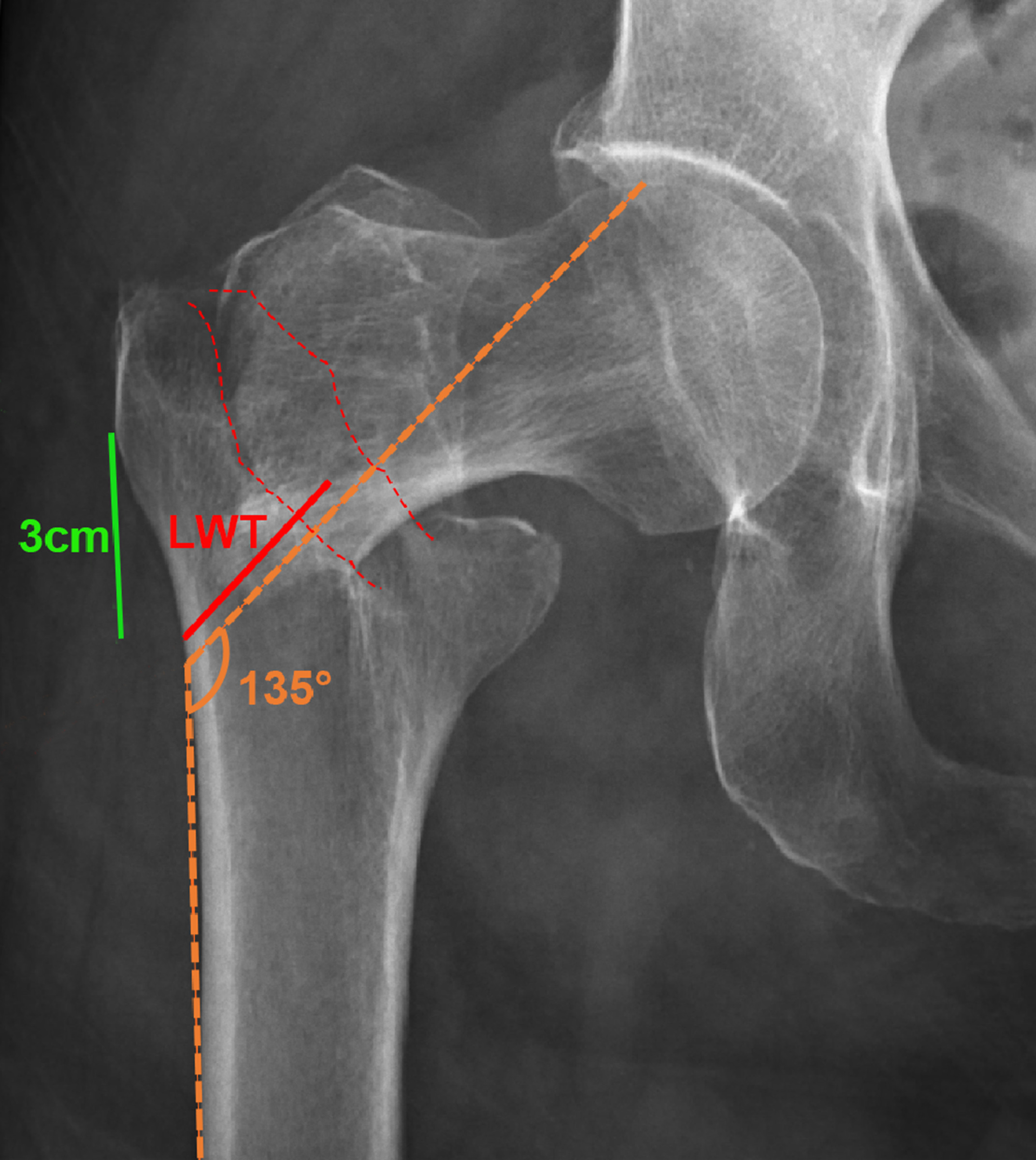 Fig. 1 
            Lateral femoral wall thickness (LWT) measuring. LWT (red solid line) is determined by measuring the distance from a reference point 3 cm (green line) below innominate tubercle of greater trochanter, using an angled approach of 135° until reaching the fracture line (the mid-line between the two cortex lines (red dashed line)) on anteroposterior radiograph.
          