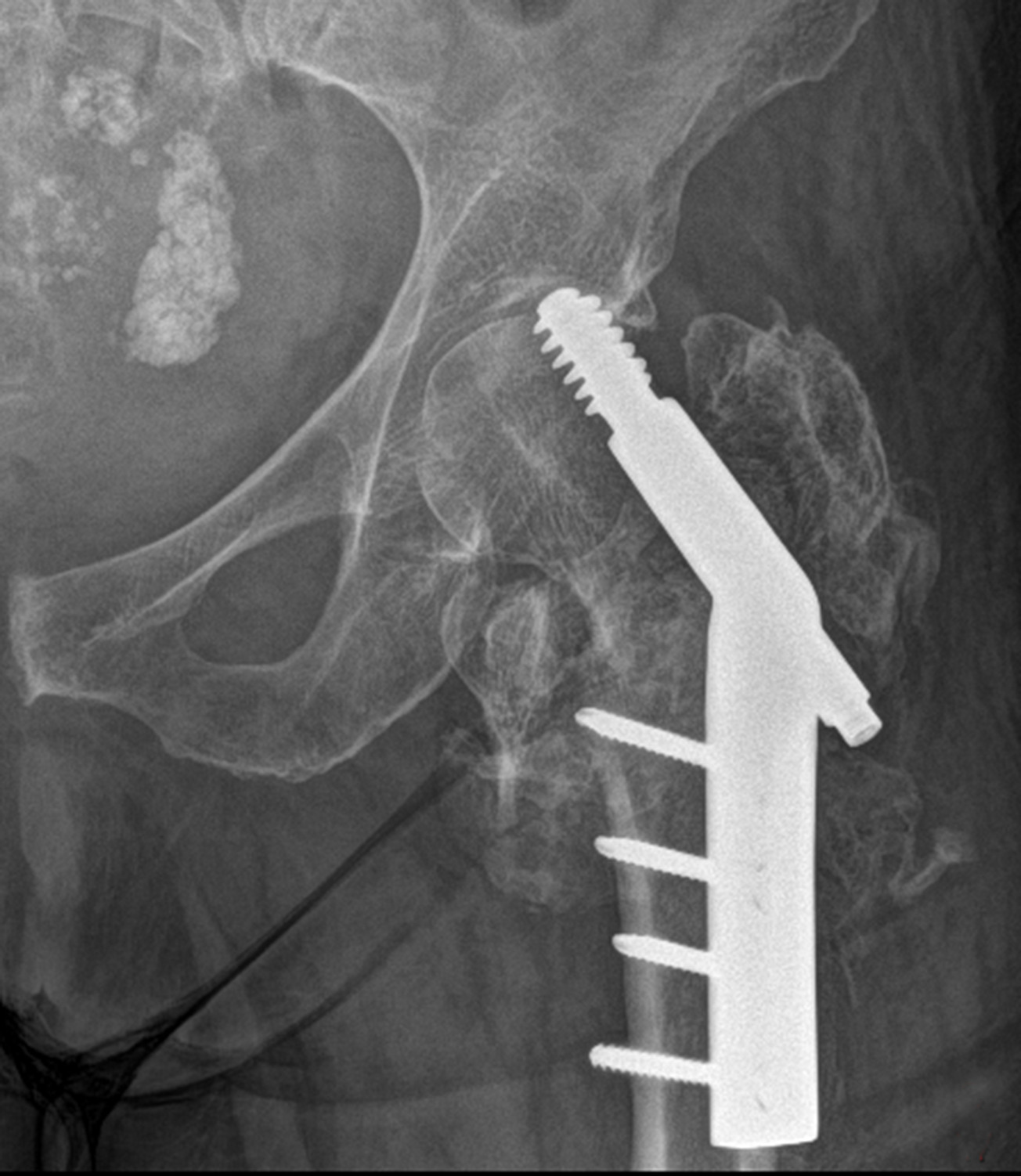 Fig. 3 
          Postoperative radiograph showing lateral wall fracture and cutout of the sliding hip screw from the femoral head into the hip joint.
        