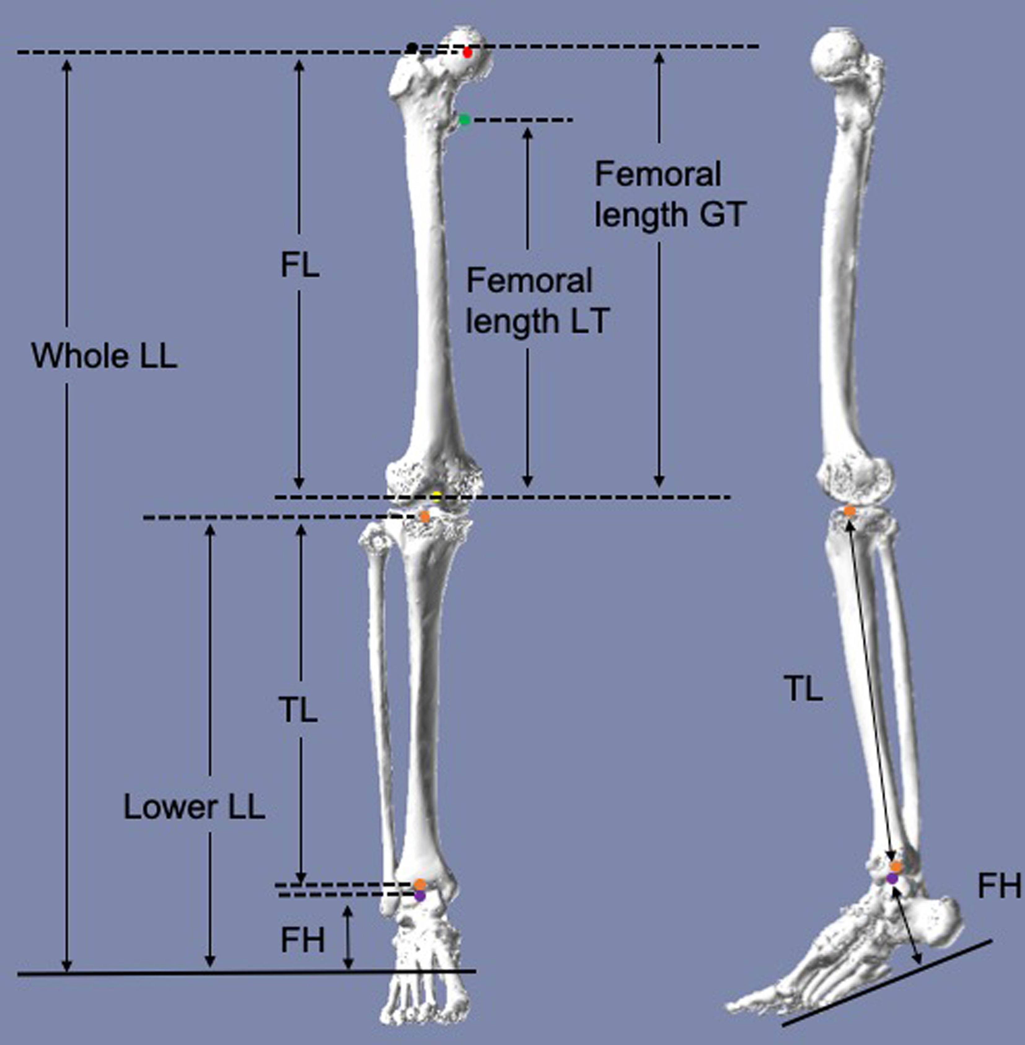 Fig. 1 
            Measurements in this study. Anatomical femoral length (FL) was defined as the distance between the centre of the femoral head (red point) and the knee centre of the femur (yellow point). Femoral length greater trochanter (GT) was defined as the vertical distance from the top of the GT (black point) to the mostdistal end of the intercondylar notch (yellow point). Femoral length lesser trochanter (LT) was defined as the vertical distance from the most medial prominence of the LT (green point) to the most distal end of the intercondylar notch (yellow point). Lower leg length (LL) was defined as the sum of tibial length (TL) andfoot height (FH). Whole LL was defined as the sum of FL and lower LL.
          