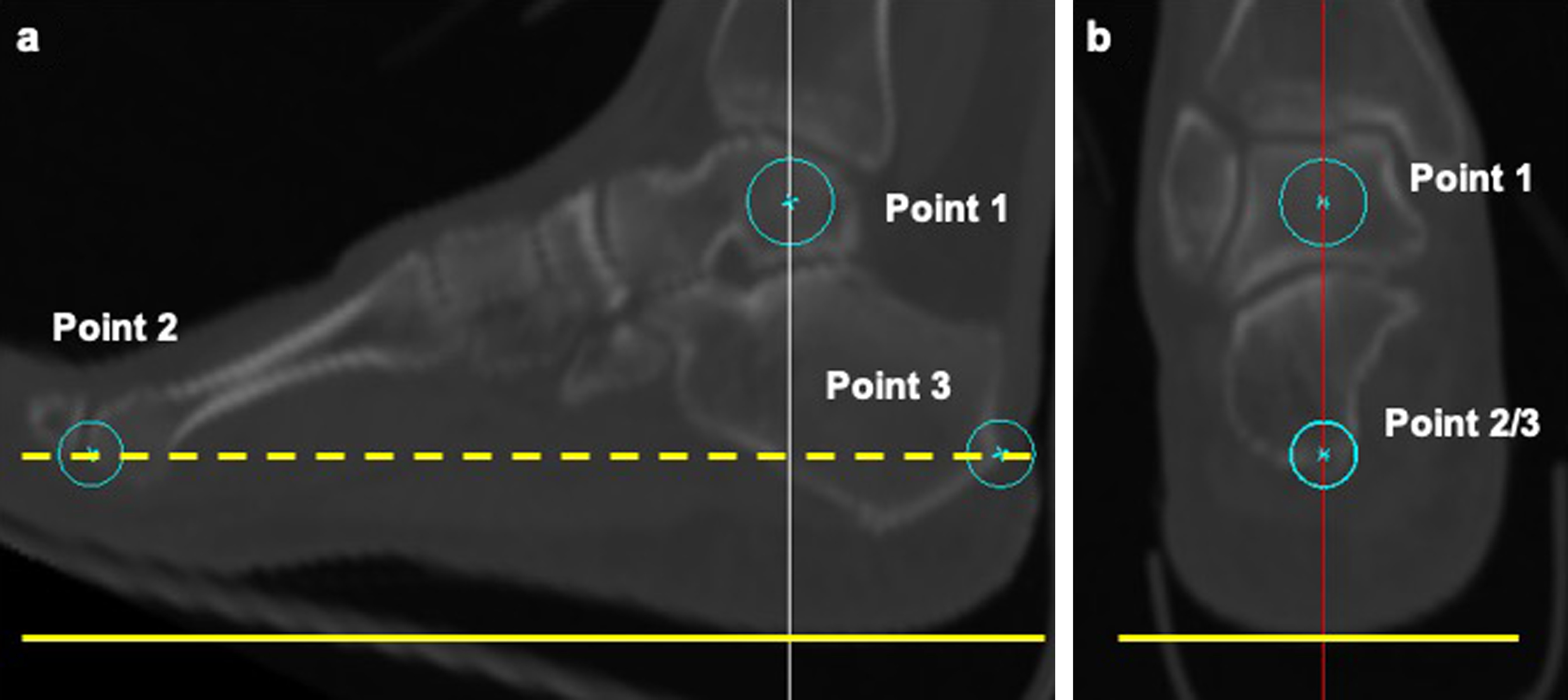 Fig. 3 
            a) Sagittal plane of the foot consisted of the centre of the talus (point 1), the most distal point of the head of the second metatarsal (point 2), and the most proximal point of the calcaneus (point 3). b) Plane perpendicular to the sagittal plane of the foot, including points 2 and 3, was defined as the plane parallel to the horizontal foot plane (yellow dotted line: plane 1). The plane parallel to plane 1 to the lowest point of the plantar surface of the heel was defined as the axial plane of the foot (yellow straight line).
          