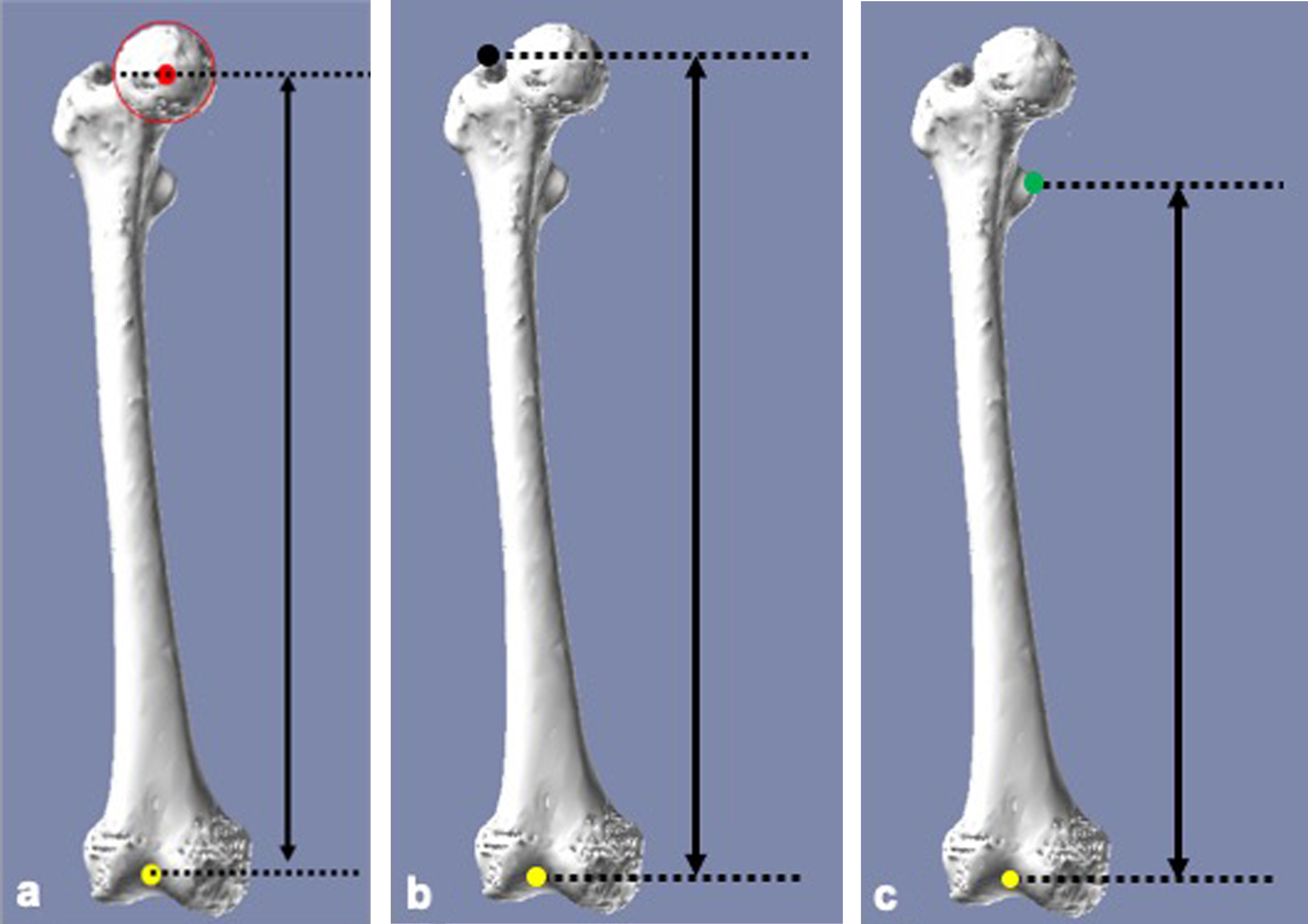 Fig. 4 
            a) Anatomical femoral length was defined as the distance between the centre of the femoral head (red point) and the knee centre of the femur (yellow point). b) Femoral length greater trochanter (GT) was defined as the vertical distance from the top of the GT (black point) to the most distal end of the intercondylar notch (yellow point). c) Femoral length lesser trochanter was defined as the vertical distance from the most medial prominence of the lesser trochanter (green point) to the most distal end of the intercondylar notch (yellow point).
          