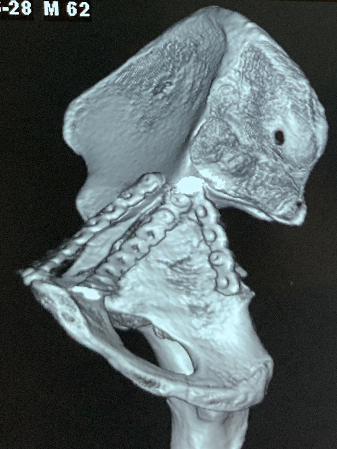 Fig. 1 
          3D CT scan of right hemipelvis with digital subtraction of opposite hemipelvis and sacrum in a postoperative case of transverse acetabulum fracture showing posterior column plating along the border of sciatic notch on the inner surface of the posterior column. The fracture was also fixed with an infrapectineal and suprepectinial plate.
        