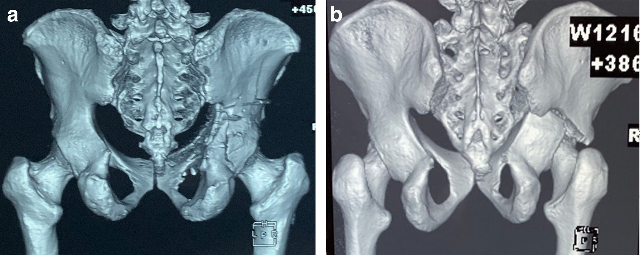 Fig. 2 
          a) 3D CT scan of a pelvis in a postoperative case of anterior column posterior hemitransverse acetabulum fracture showing oblique orientation of posterior column fracture line which was buttressed with reconstruction plate along the border of sciatic notch on the inner surface of posterior column, neutralizing medial force of head of femur, as well as preventing proximal migration of apex of distal fragment. b) 3D CT scan of pelvis in a case of transverse acetabulum fracture showing horizontal orientation of posterior column fracture line, which can be fixed with reconstruction plate along the border of sciatic notch on the inner surface of posterior column; although this neutralizes the medial force of head of femur, interfragmentary compression should be applied with clamps before fixation, since compression is not possible with this technique as it would be possible with antegrade posterior column screw fixation.
        