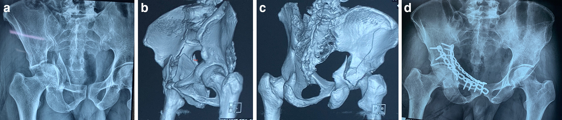 Fig. 4 
            a) Anteroposterior Radiographic view of 55 year-old male showing anterior column posterior hemitransverse (ACPHT) acetabulum fracture with seagull sign and medial subluxation of femoral head. b) 3D CT scan of the same patient with an ACPHT acetabulum fracture showing oblique orientation of posterior column fracture. c) 3D CT scan of the ACPHT acetabulum fracture showing displaced anterior column and medially displaced quadrilateral plate. d) Immediate postoperative radiograph showing anatomical reduction of fracture with vertical posterior column plate, infrapectineal, and suprapectineal plate.
          