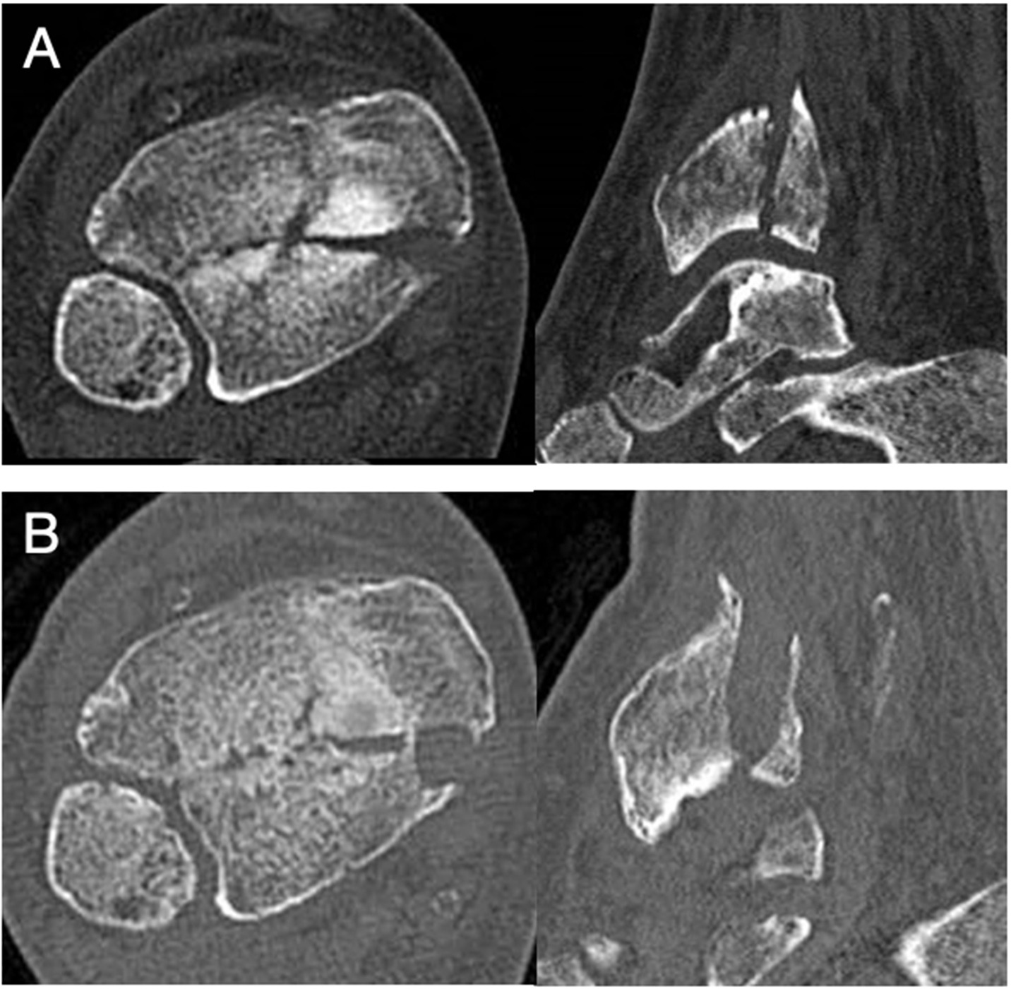 Fig. 2 
          CT scans showing a case of tibialis posterior tendon entrapment following fixation of a posterior malleolar fracture. a) Six weeks post-surgery. b) Encapsulated tendon forming its own tunnel in the healed fracture site.
        