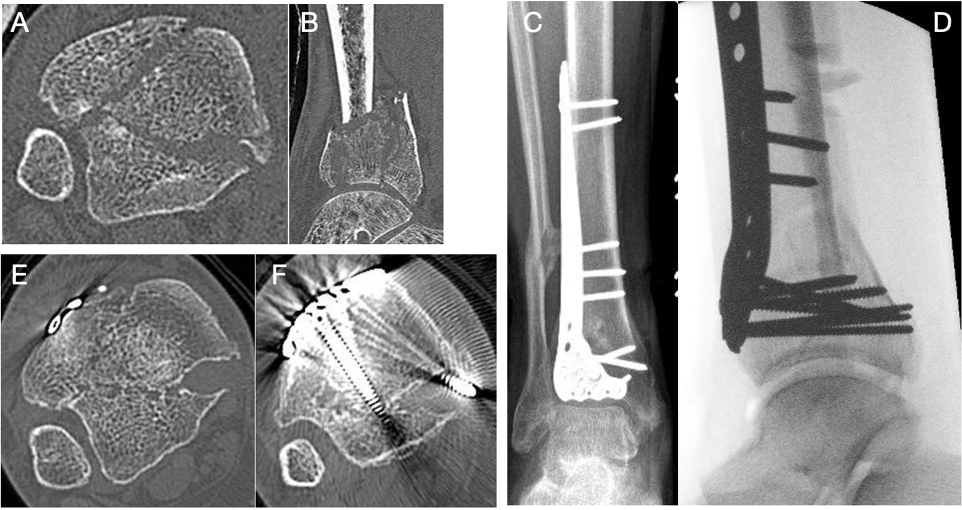 Fig. 3 
            Case of tibialis posterior (TP) entrapment following fixation of a pilon fracture. a) and b) Initial CT scans show that the fracture enters the TP sheath. c) and d) Postoperative and intraoperative fixation of the pilon. e) and f) Axial CT scans showing not only the encapsulated tendon forming its own tunnel in the healed fracture site, but also a screw encroaching on the TP from the anterior plate fixation.
          