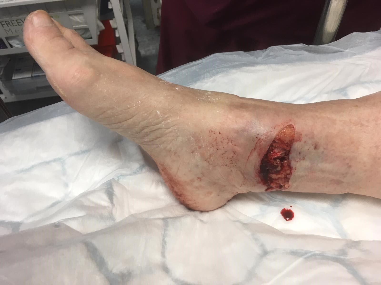 Fig. 1 
            Clinical photograph of a right open ankle fracture, demonstrating a transverse medial wound in which the skin has failed under tension.
          