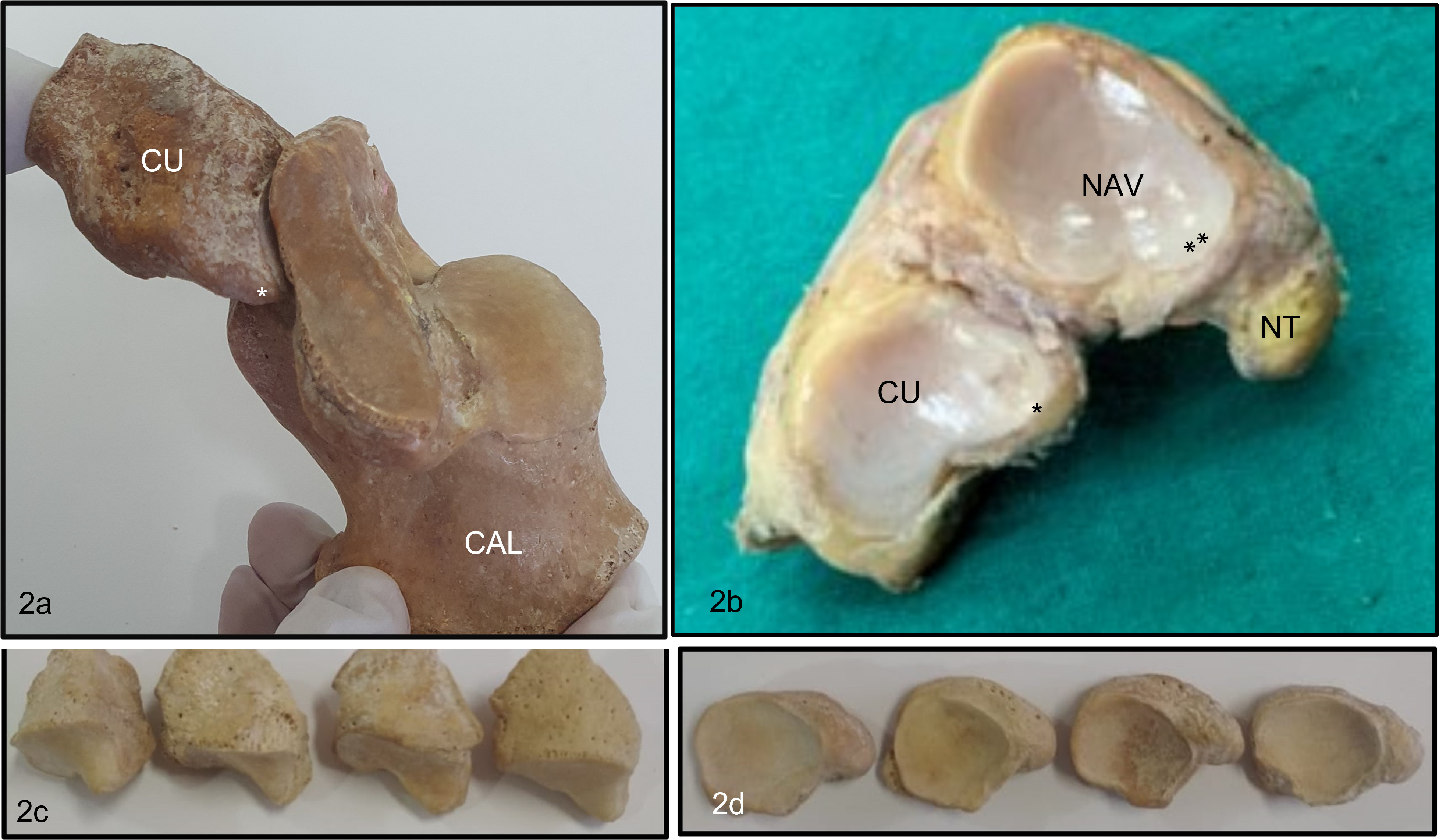 Fig. 2 
            a) Beak of cuboid fitting into the coronoid fossa of the calcaneus, b) shelf-like inferior supports of the cuboid (*) and navicular (**), c) beaks of the cuboid bone. and d) beaks of the navicular bone. CAL, calcaneus; CU, cuboid; NAV, navicular; NT, navicular tuberosity.
          