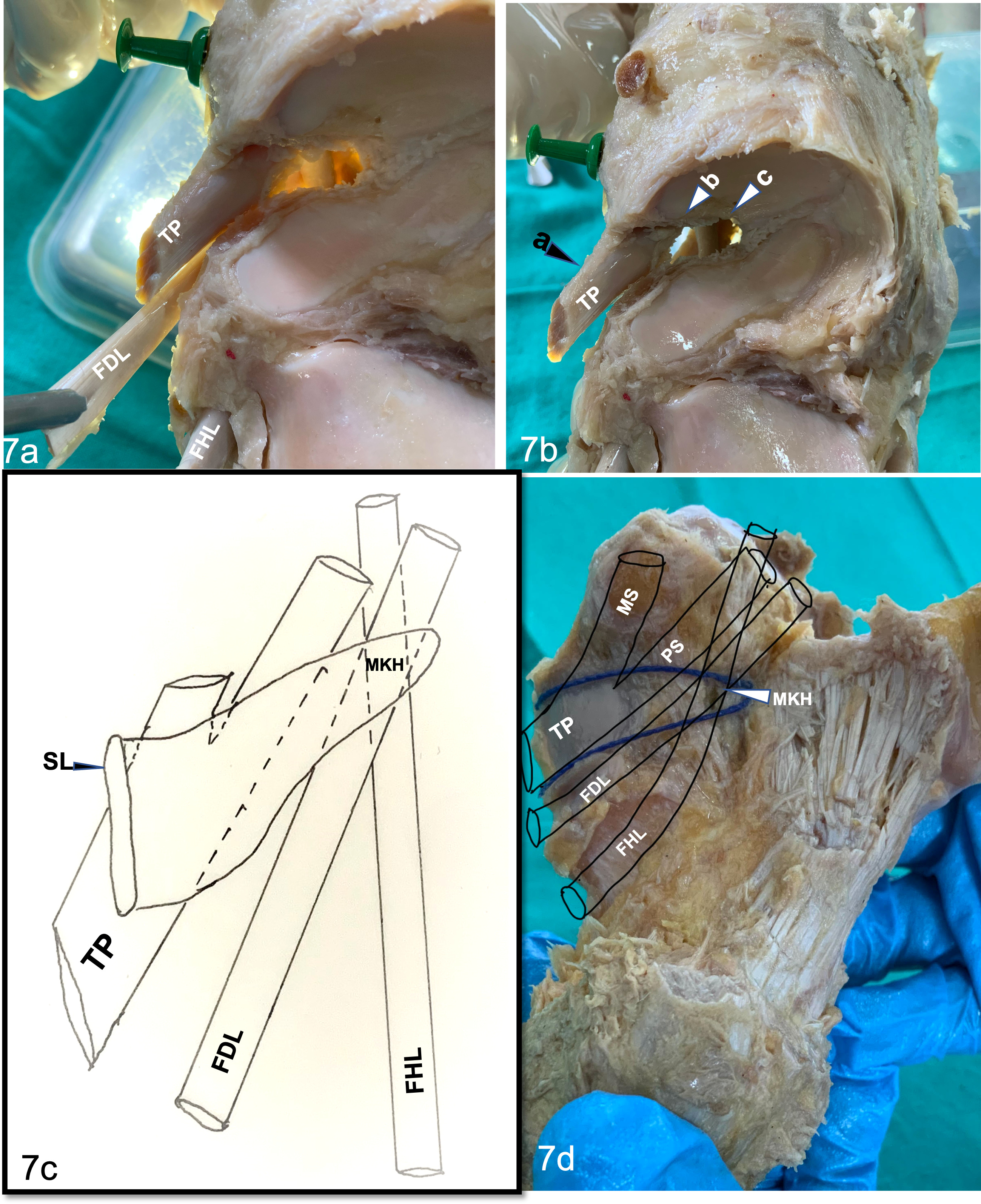 Fig. 7 
            Schematic of the dynamic support system of the talocalcaneonavicular (TCN) joint. Tendinous reinforcement of TCN joint as seen from above after removing talus and the spring ligament. Note the main tendon of tibialis posterior (TP) buttressing the highest and widest part of the osseous gap. a) TCN joint medially, b) the planter slips of tibialis posterior reinforcing inferomedially, and c) and the master knot of Henry (MKH) reinforcing the joint inferiorly. The schematic representation of the spring ligament with superimposition of dynamic supports reinforcing its different parts: the thread shows the spring ligament, demonstrating various parts of the spring ligament complex seen from the inferior aspect with schematic superimposition of dynamic supports, reinforcing its different parts. FDL, flexor digitorum longus; FHL, flexor hallucis longus; MS, main slip of the tendon of tibialis posterior, PS, planter slip of the tendon of tibialis posterior.
          