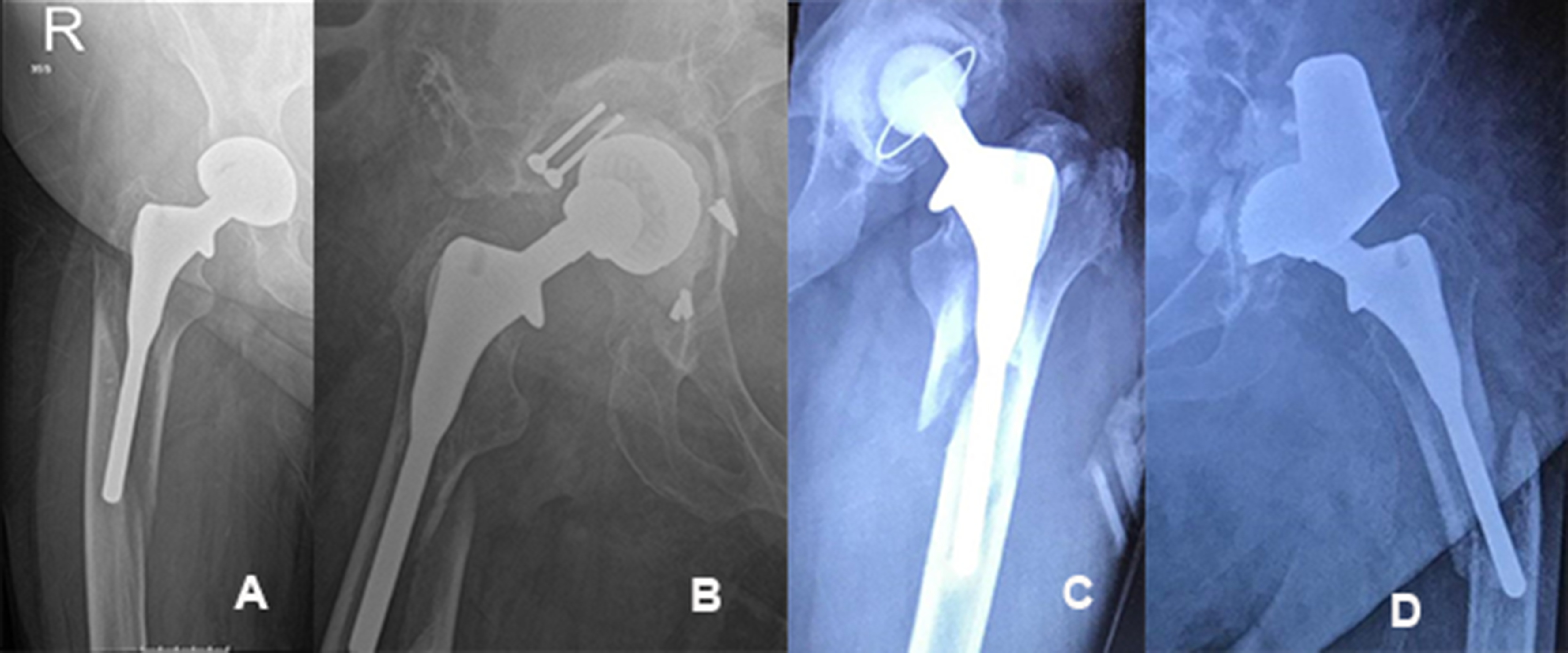 Fig. 3 
          Radiographs of patients with periprosthetic fractures. a) 60-year-old female, who was aged 51 years when the fracture occured. b) 76-year old female, who was aged 66 years when the fracture occured. c) 72-year old male, who was aged 67 years when the fracture occured. d) 67-year-old male, who was aged 62 years when the fracture occured.
        