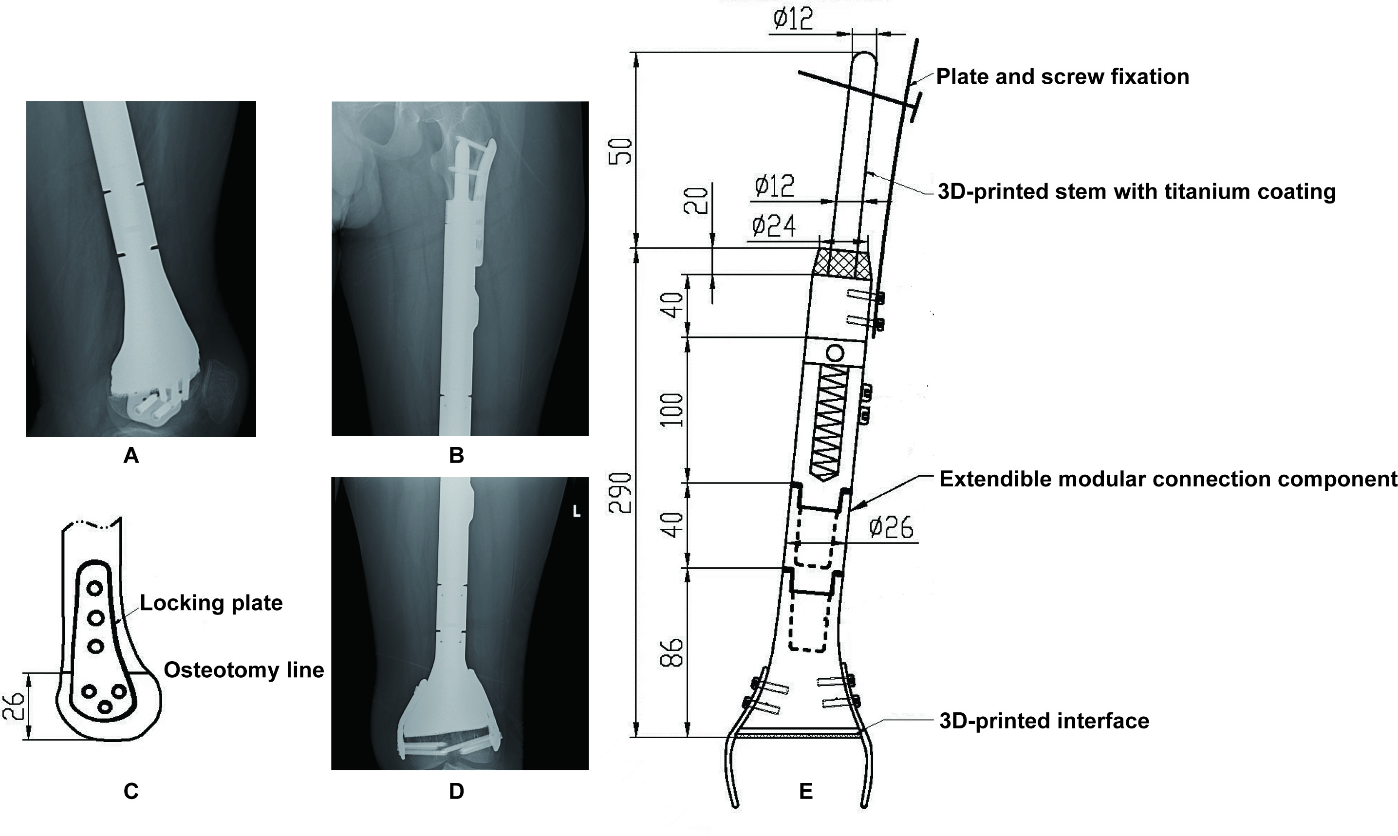Fig. 1 
              Radiographs and design of the 3D-printed prosthesis of a ten-year old male. a) Lateral radiographs of the distal component 20 months postoperatively; b) anteroposterior radiographs of proximal stem; c) distal 3D-printed component on design proposal fixed by the locking screw and plate; d) anteroposterior radiographs of the distal component; and e) the gross view of the prosthesis on design proposal showing the proximal 3D-printed stem with a titanium coating, a modular connection component in the middle part, and a distal 3D-printed component.
            