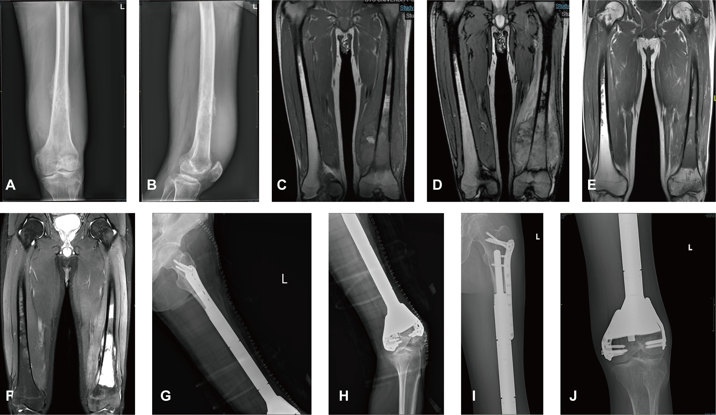 Fig. 2 
              A 31-year-old male patient complained of increasing left thigh pain during the last 12 months, and was found to have Ewing’s sarcoma in the mid-shaft femur. a) and b), preoperative radiographs showing bone destruction of the distal femur. c) and d) T1-weighted and T2-weighted MRI before chemotherapy. e) and f) T1-weighted and T2-weighted MRI after six courses of chemotherapy revealed dramatic shrinkage of the tumour. g) and h) Postoperative radiographs. i) and j) Radiography showed an excellent position of the 3D-printed prosthesis and the Musculoskeletal Tumor Society score was 28 at the 30-month follow-up.
            
