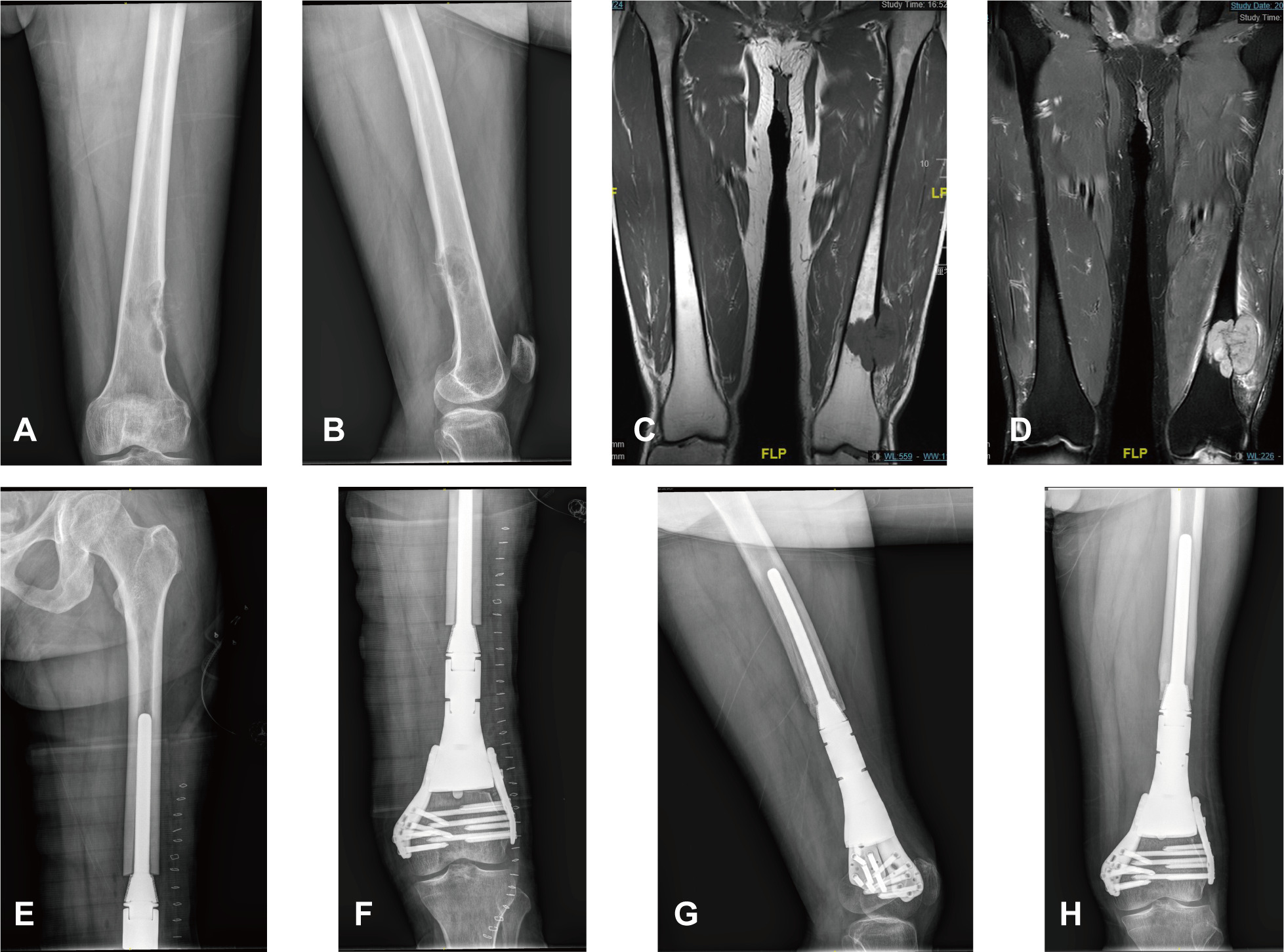 Fig. 3 
          A 51-year-old male with undifferentiated pleomorphic sarcoma experienced progressive left thigh pain for sixmonths. a) and b) preoperative radiograph; c) and d) T1-weighted and T2-weighted MRI before chemotherapy; e) and f) postoperative radiograph; and g) and h) radiography demonstrating an excellent position of the prosthesis. The Musculoskeletal Tumor Society score was 27 at 44-month follow-up.
        