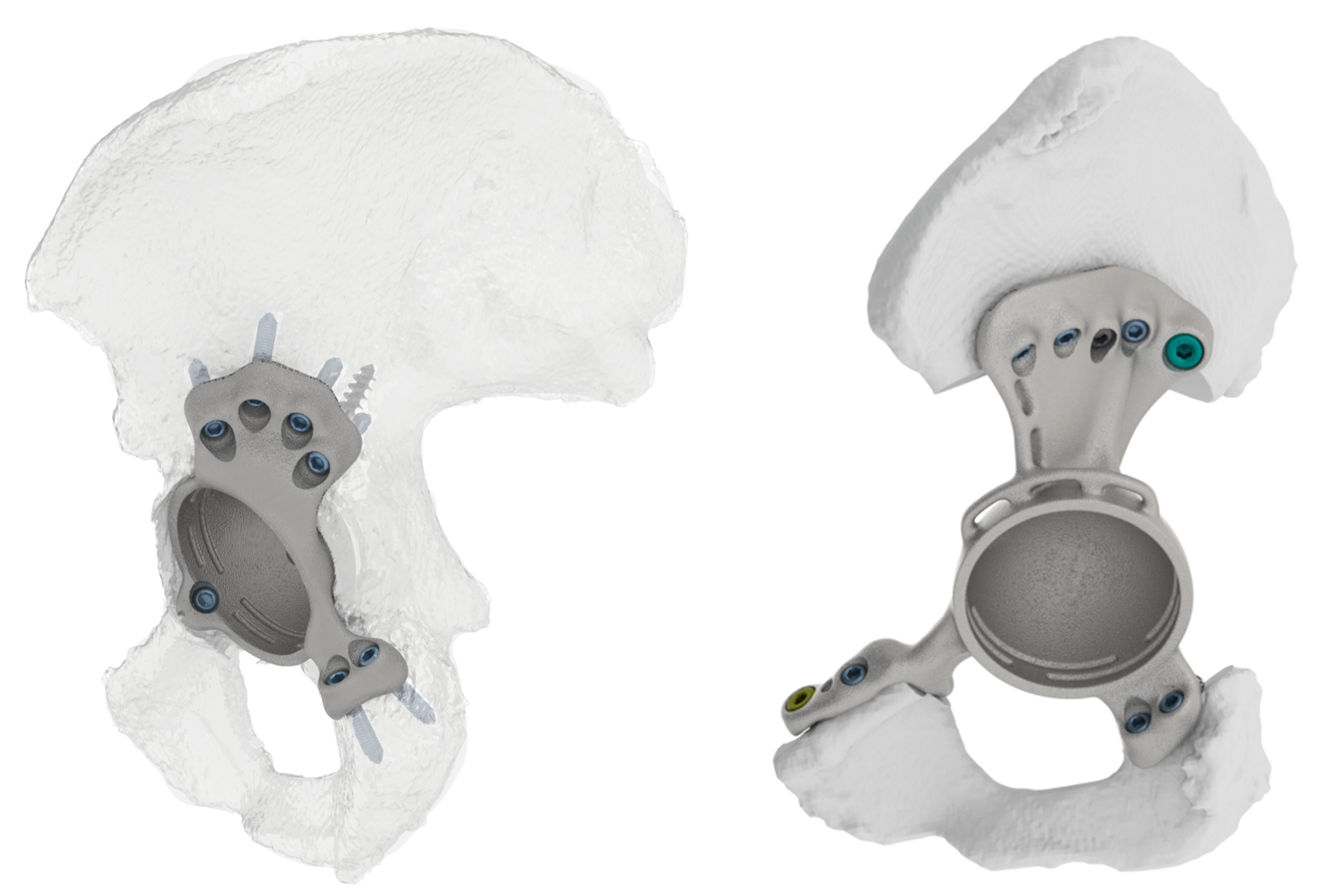 Fig. 1 
            Two custom triflange acetabular component implant designs. The left shows a total hip arthroplasty revision implant; the right shows a hemipelvectomy reconstruction implant.
          