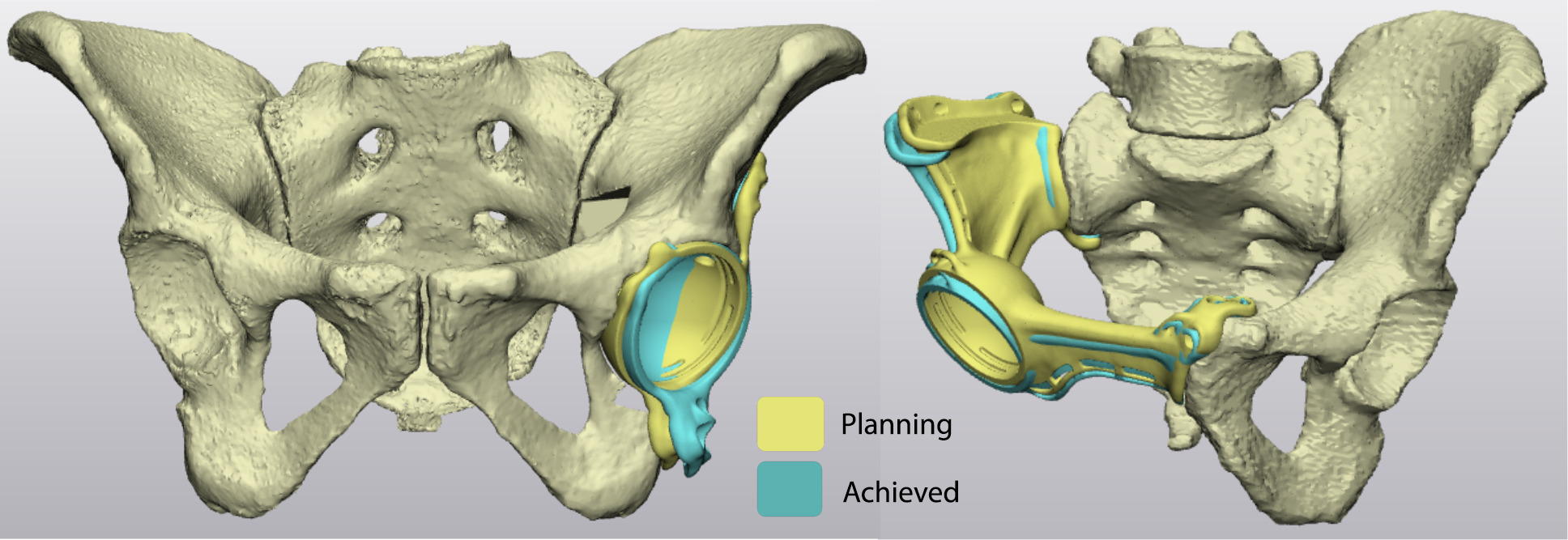 Fig. 2 
            An optical representation of two studied cases. Yellow represents the preoperative planned custom triflange acetabular component position, and cyan represents the achieved implant position.
          