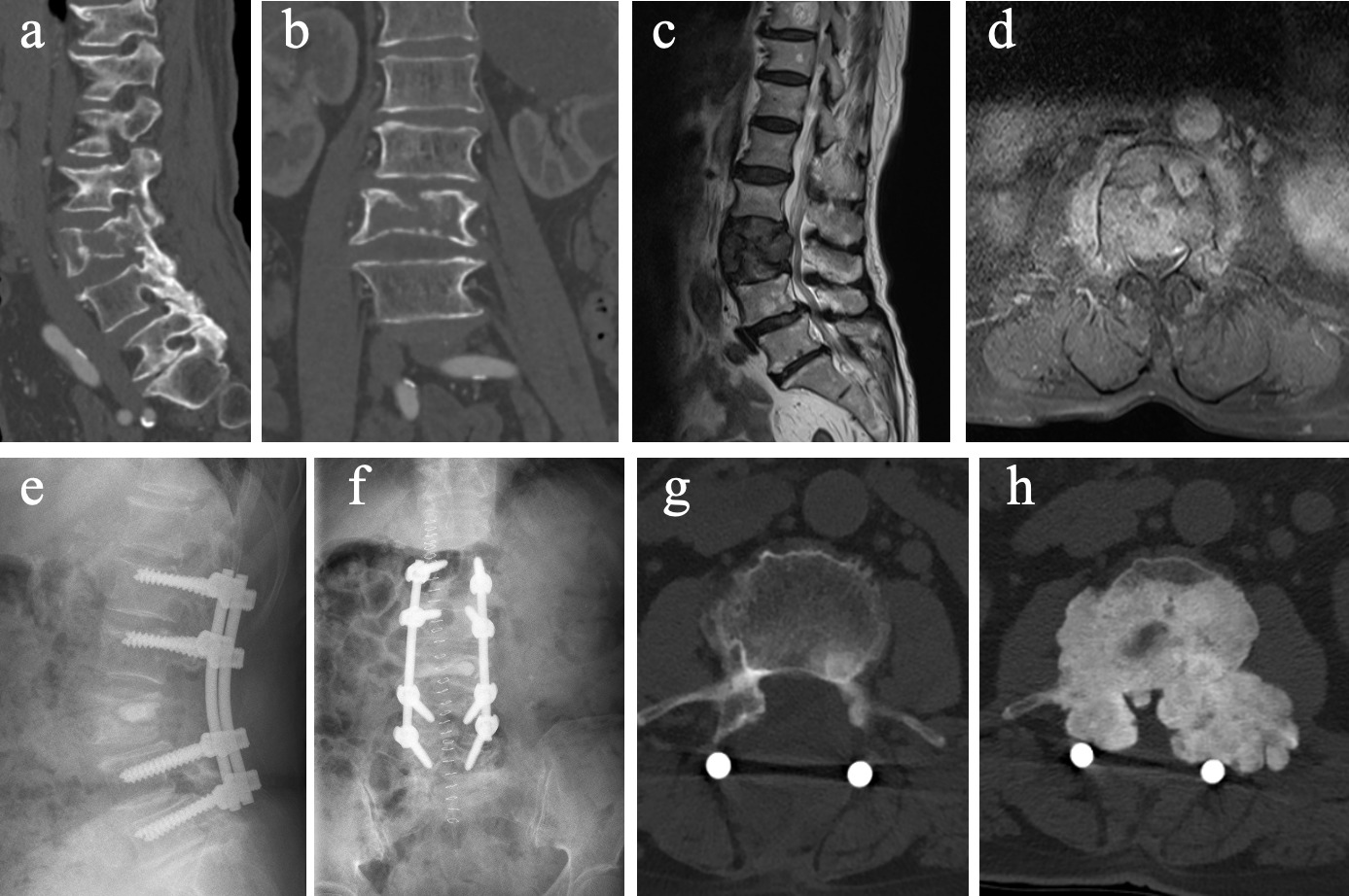 Fig. 2 
            Representative imaging of local progression after surgery in a spinal non-small-cell lung cancer (NSCLC) patient during the follow-up period. A 68-year-old female with L3 metastatic NSCLC experienced severe back pain and weakness for nearly one month. a) and b) Preoperative sagittal and axial CT imaging showed that the lesion was located at L3, accompanied by significant bone destruction. c) and d) Sagittal and axial T2-weighted magnetic resonance imaging before surgery showed that a lesion located in L3 with high-grade epidural spinal cord compression (ESCC). e) and f) Decompression surgery was performed and postoperative radiograph showed good fixation. g) and h) Postoperative axial CT scanning showed that compared with the image five days after operation. h) Significant local progression was observed in the image one year after operation.
          